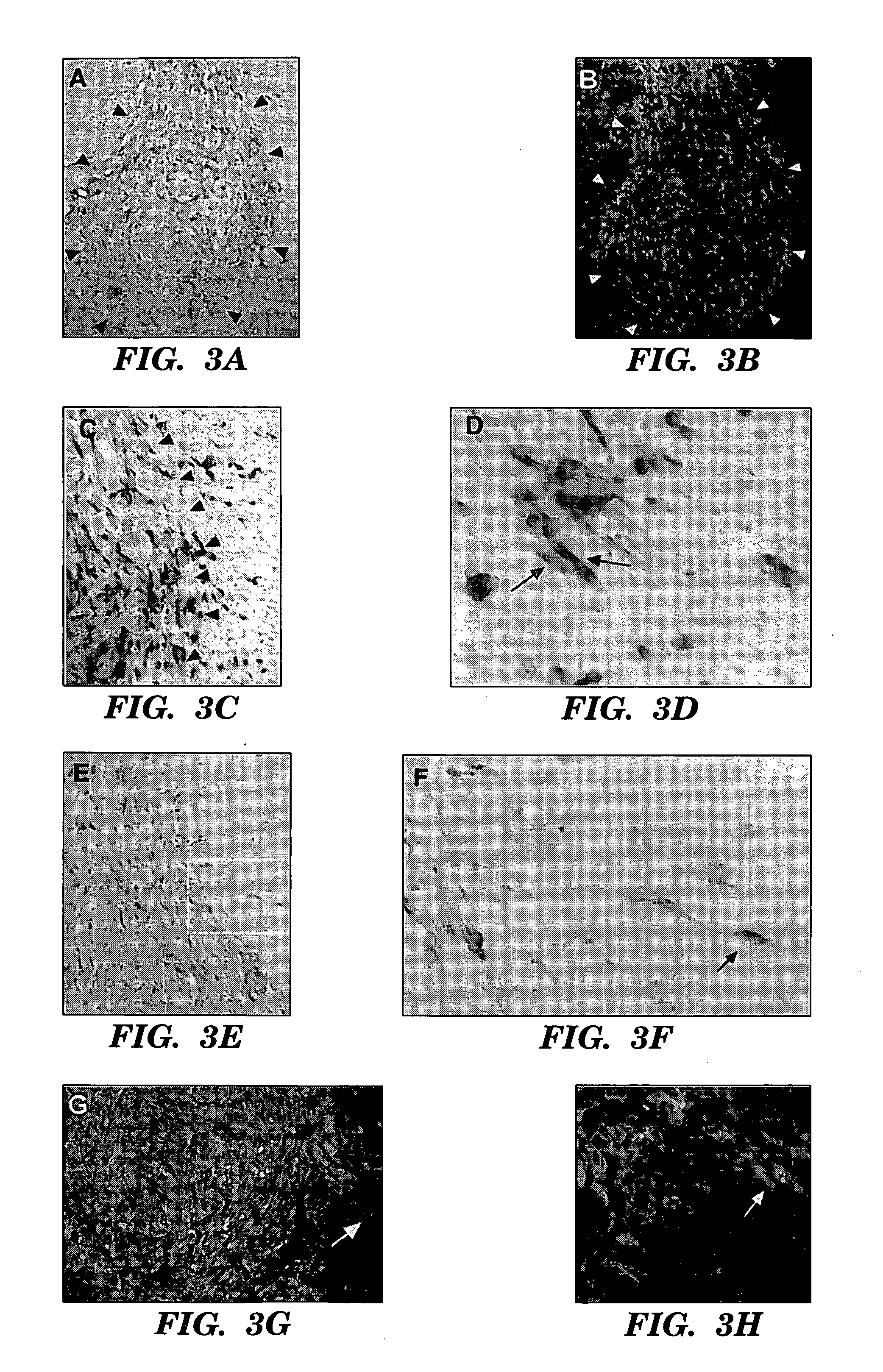 Engraftable neural progenitor and stem cells for brain tumor therapy