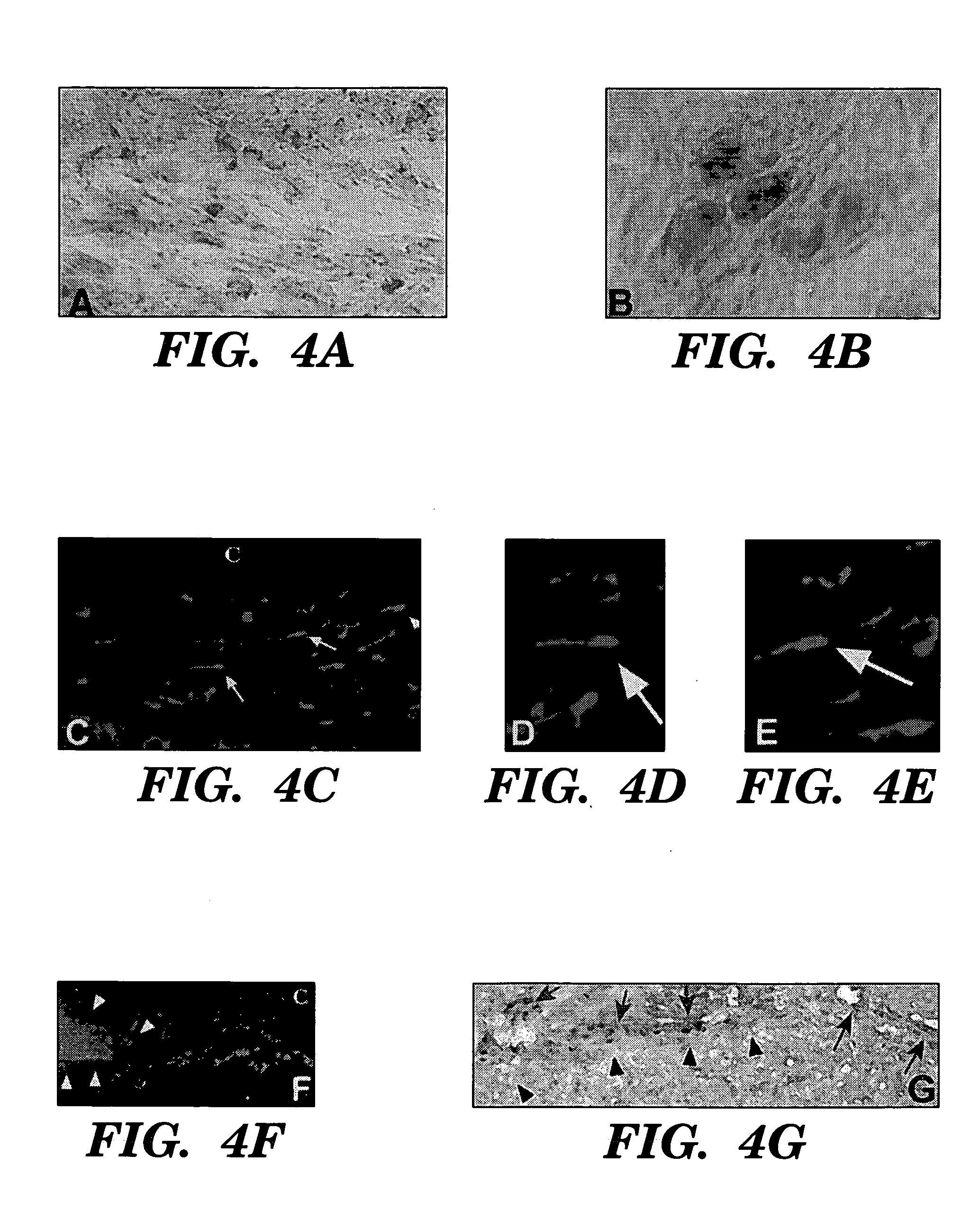 Engraftable neural progenitor and stem cells for brain tumor therapy