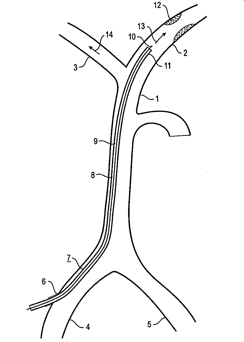 Device and method for reducing or removing stenoses