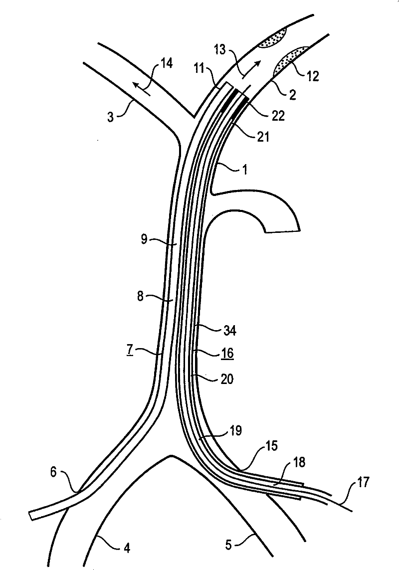 Device and method for reducing or removing stenoses