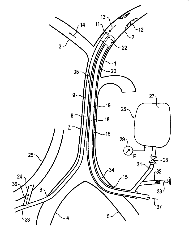 Device and method for reducing or removing stenoses