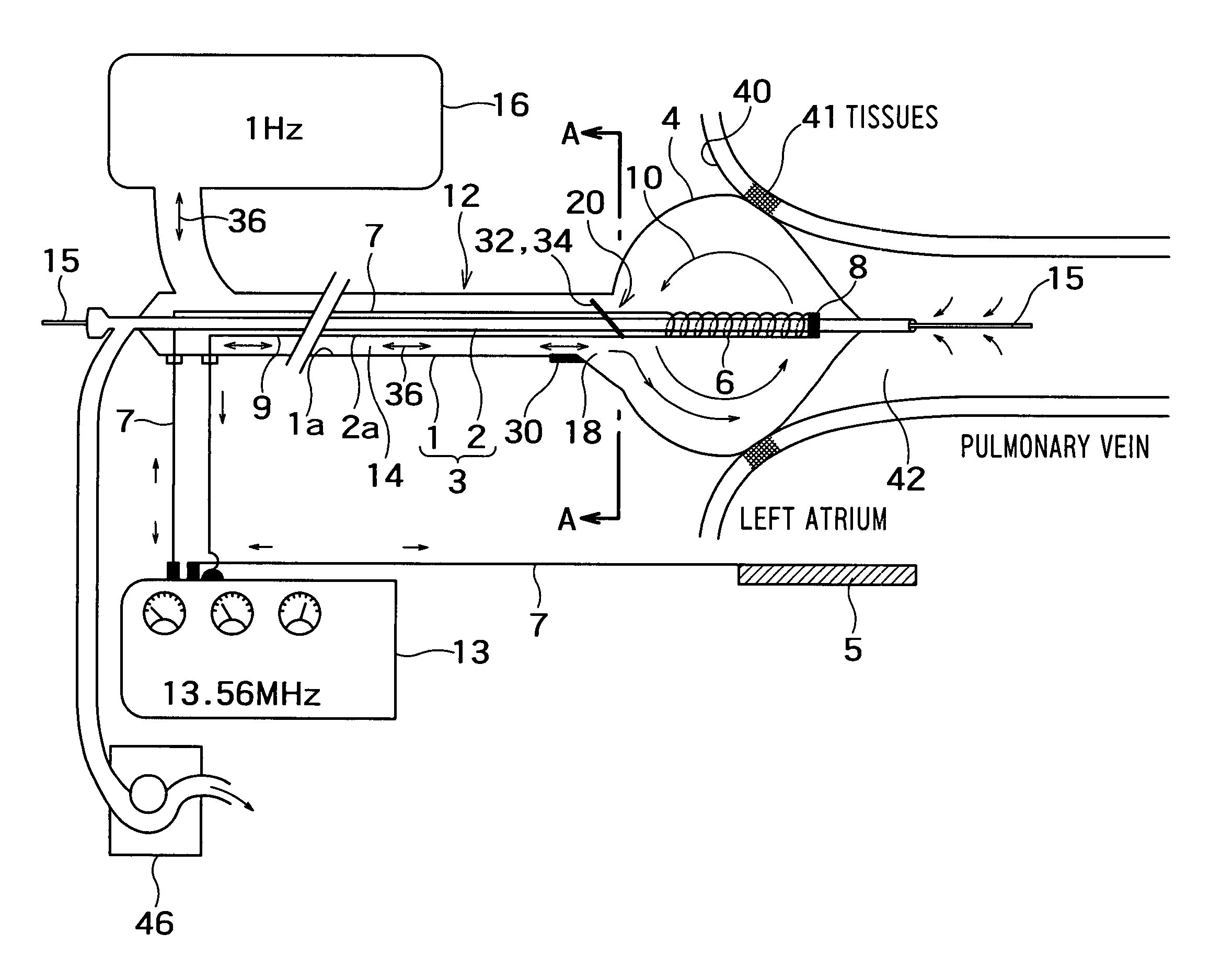 Radio-frequency thermal balloon catheter