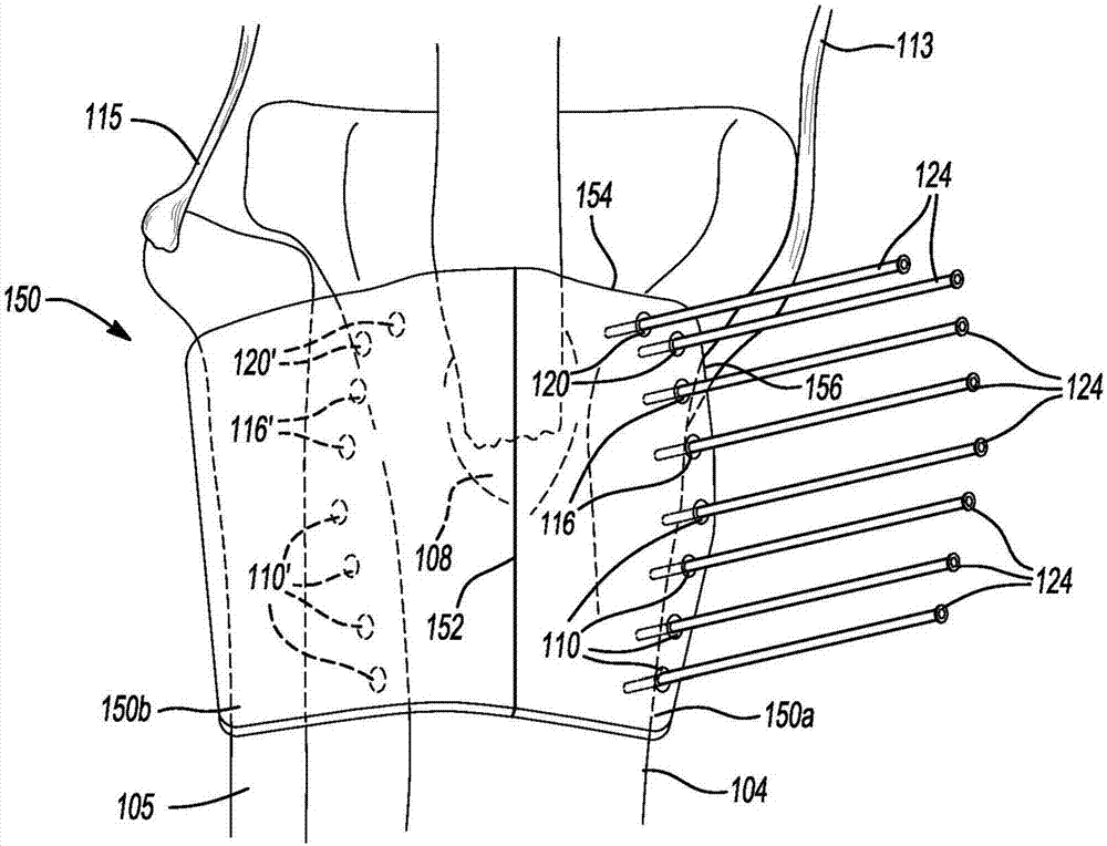 Tibial tubercle osteotomy guide