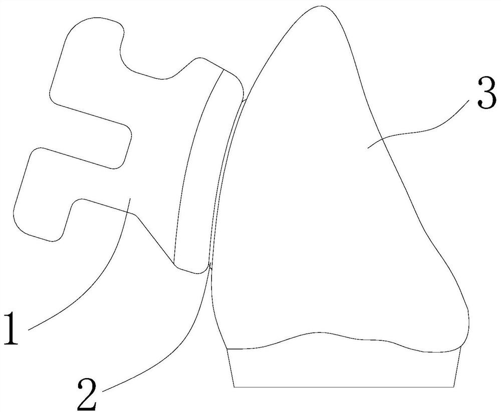 Preparation method of orthodontic zirconia bracket