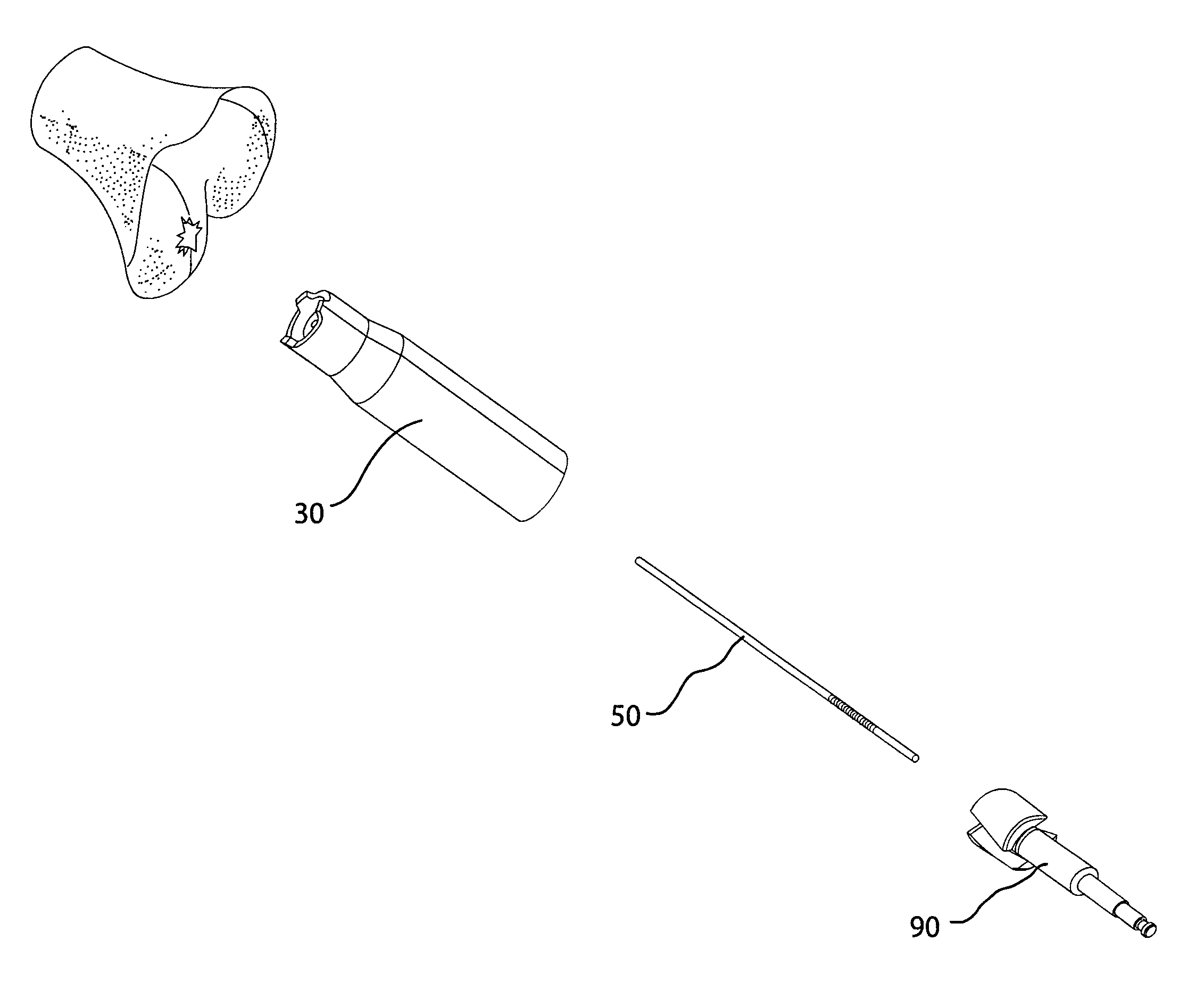 Surgical bone cutting assembly and method of using same