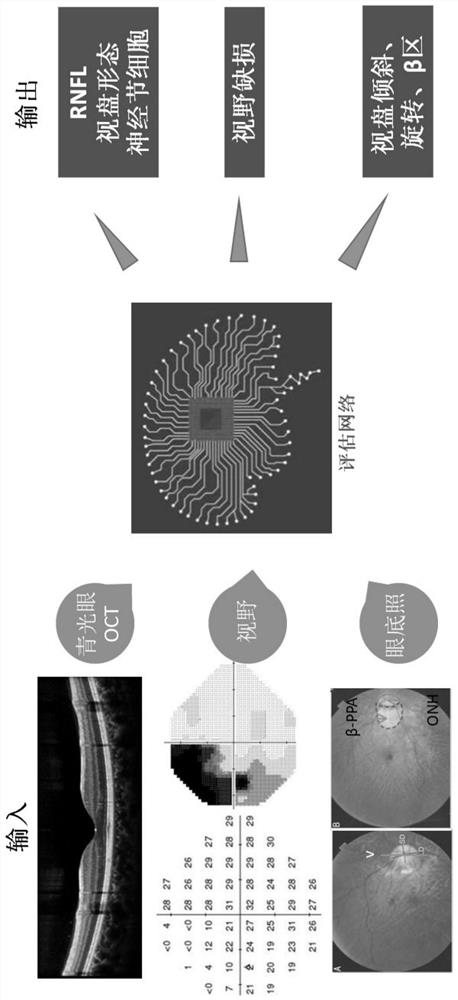 An intelligent screening system suitable for high myopia complicated by open-angle glaucoma and its establishment method