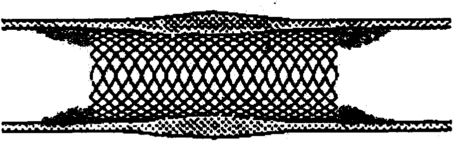 Preparation method for radioactivity TiNi alloy bracket without fringe effect