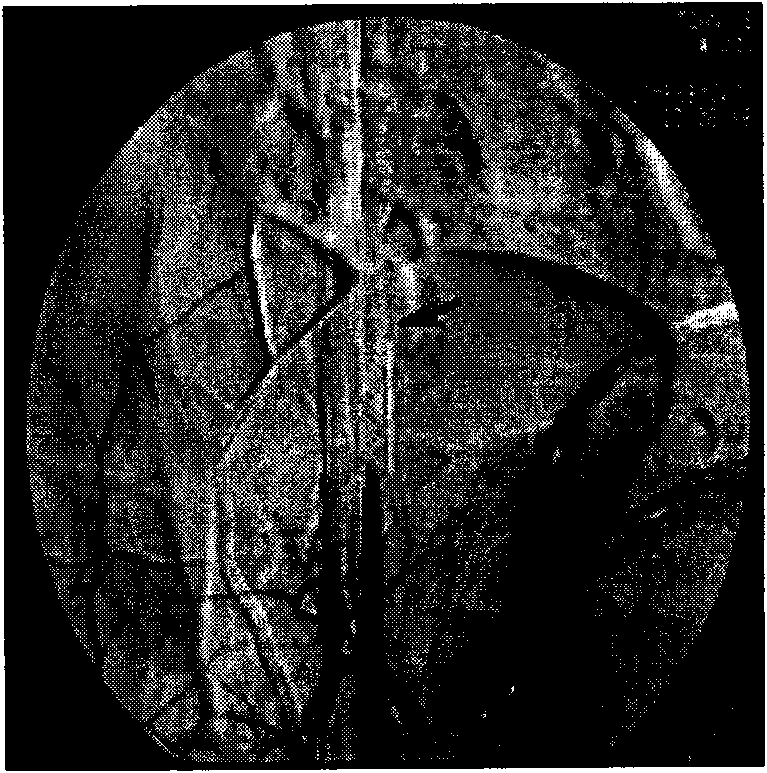 Preparation method for radioactivity TiNi alloy bracket without fringe effect