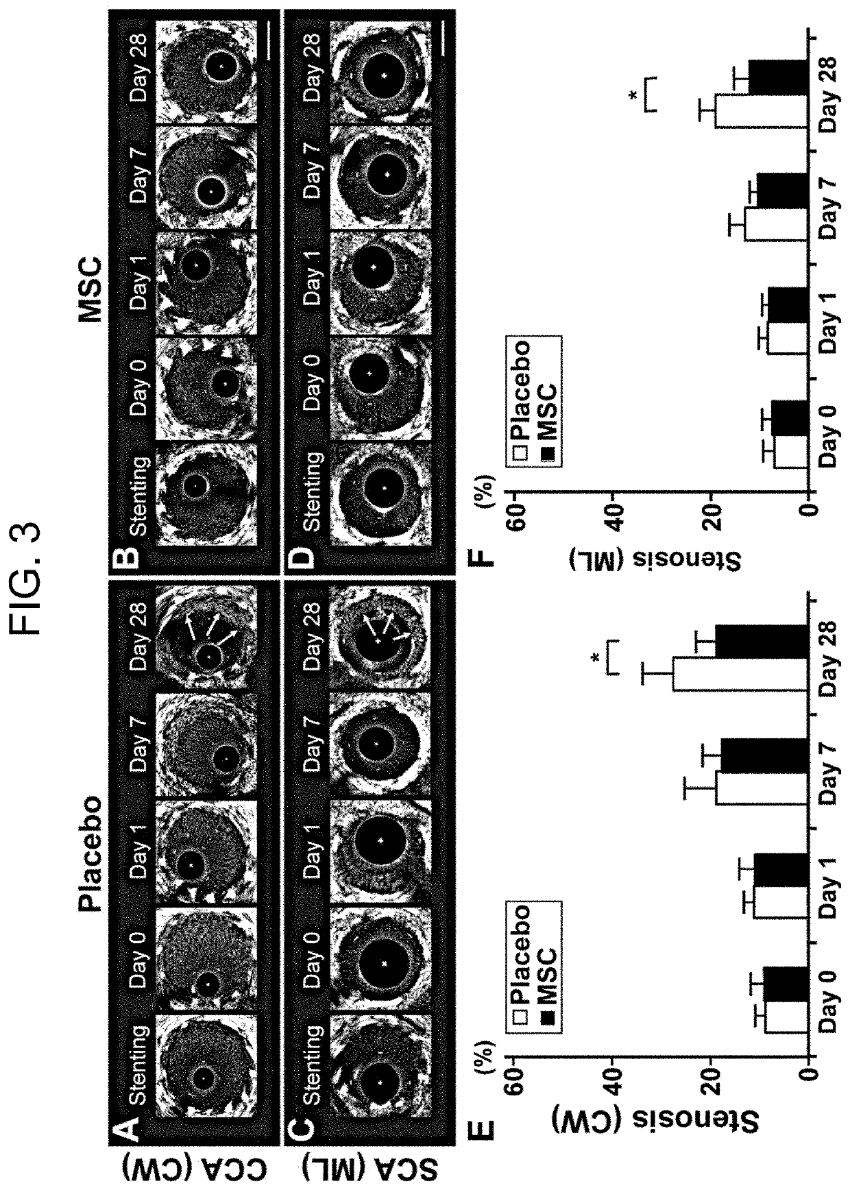 Pharmaceutical composition for preventing in-stent restenosis