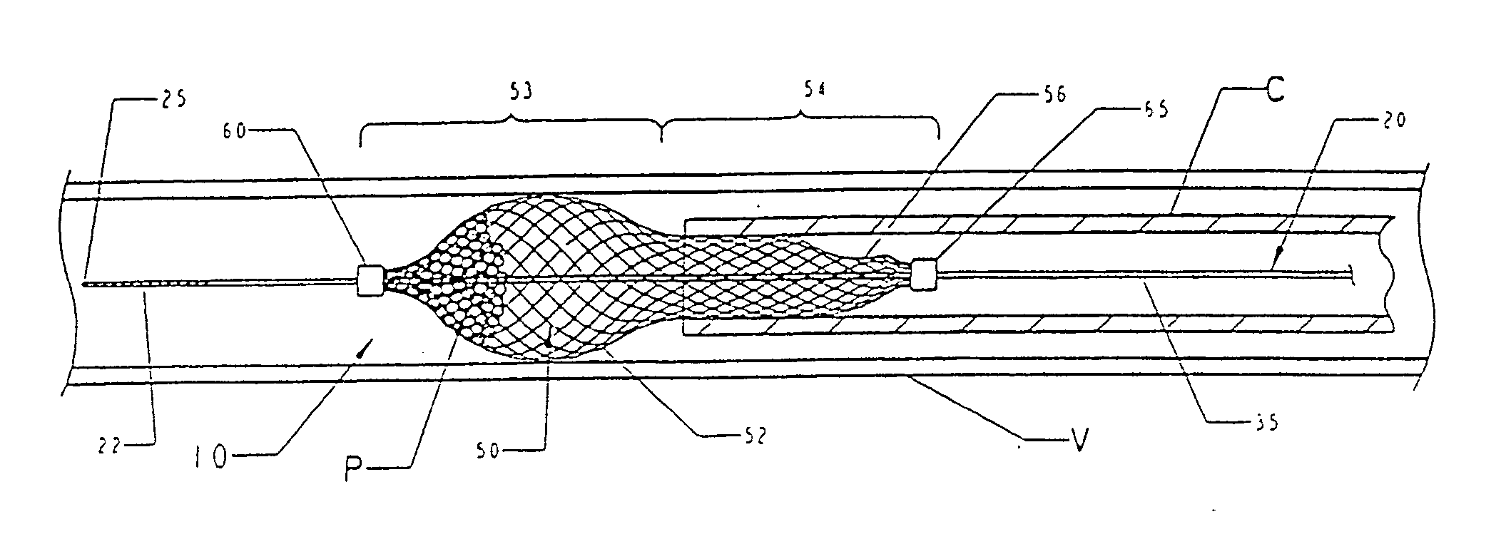 Temporary vascular filter