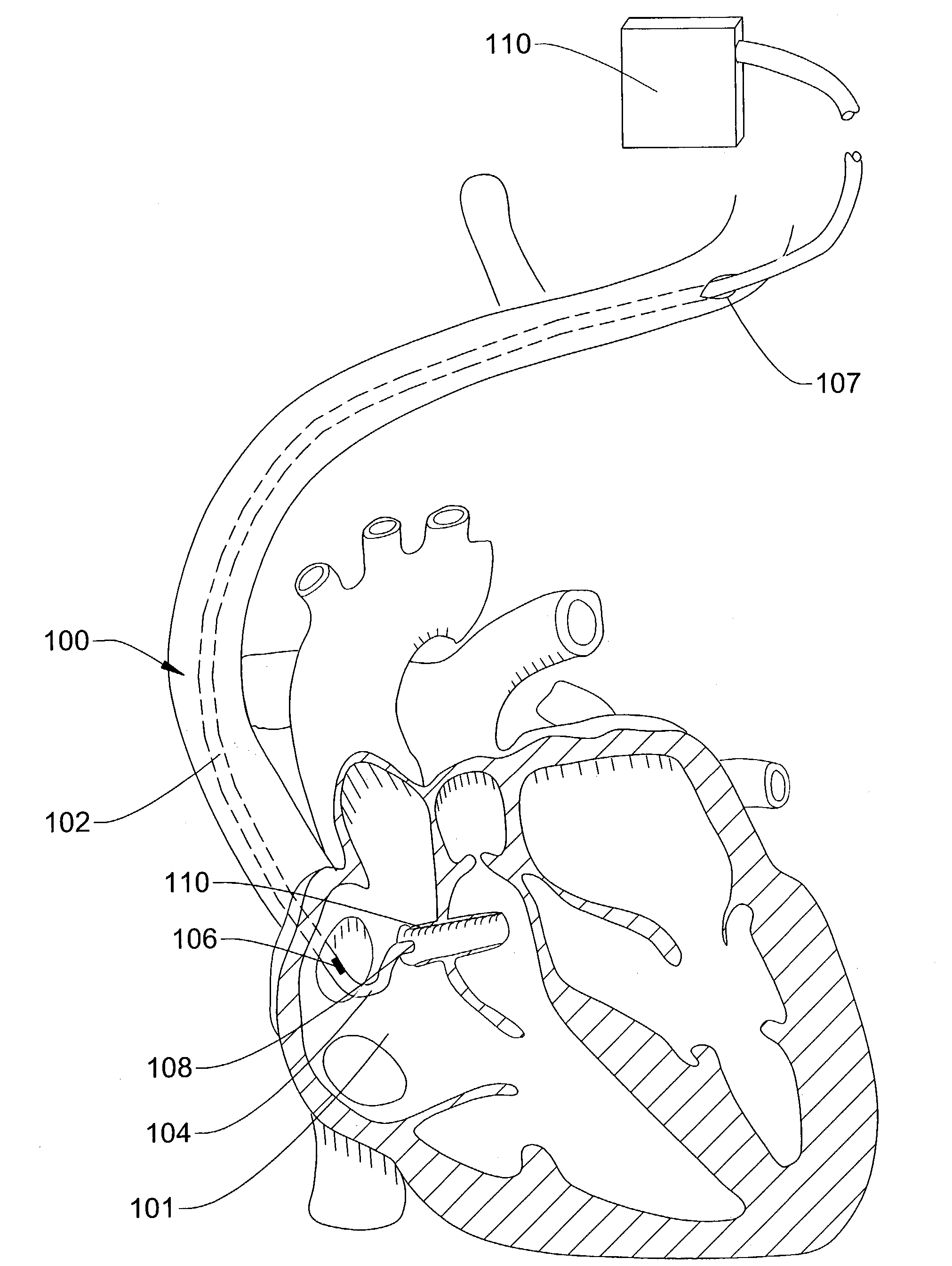 Ultrasound directed guiding catheter system and method