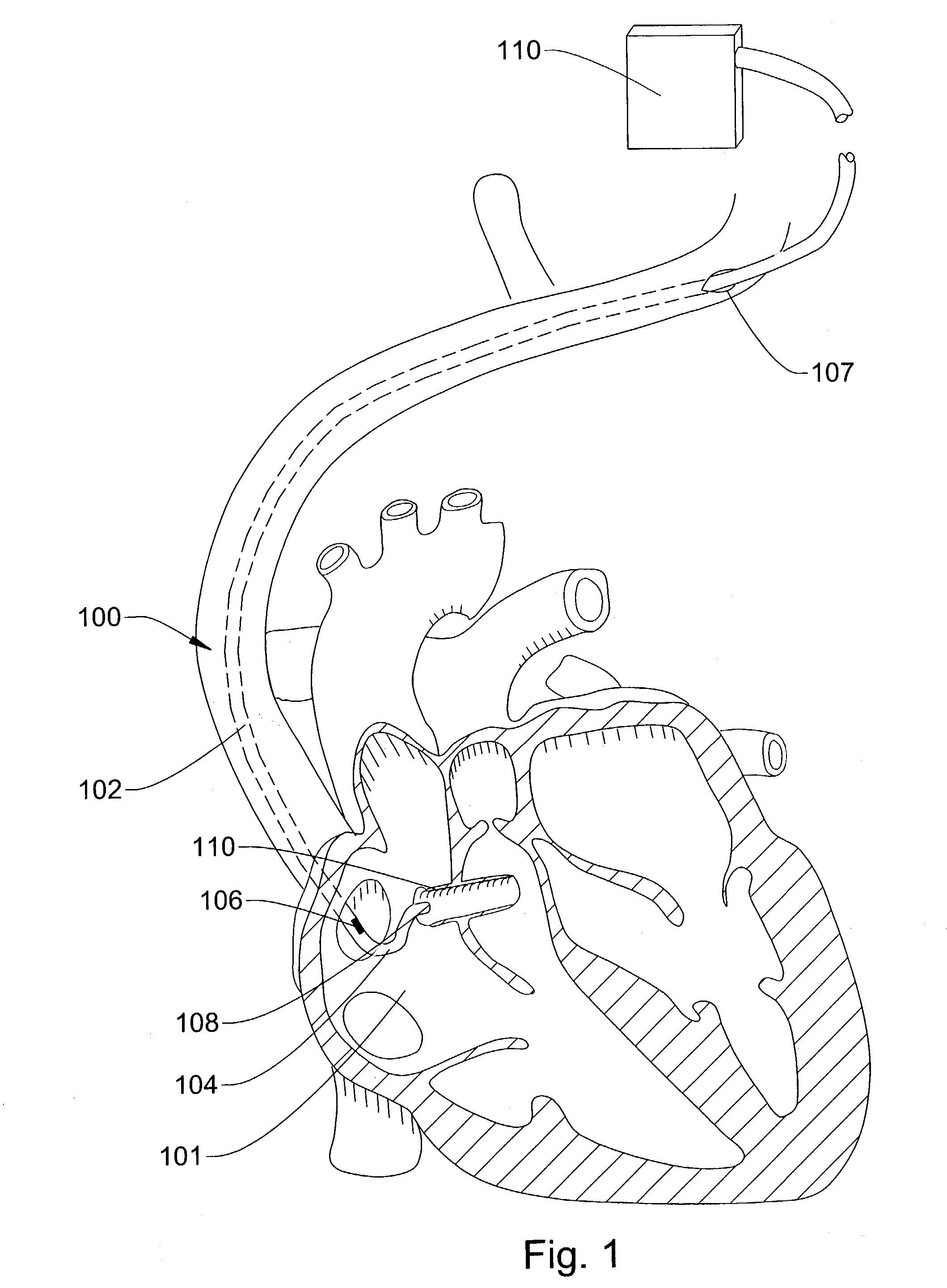 Ultrasound directed guiding catheter system and method