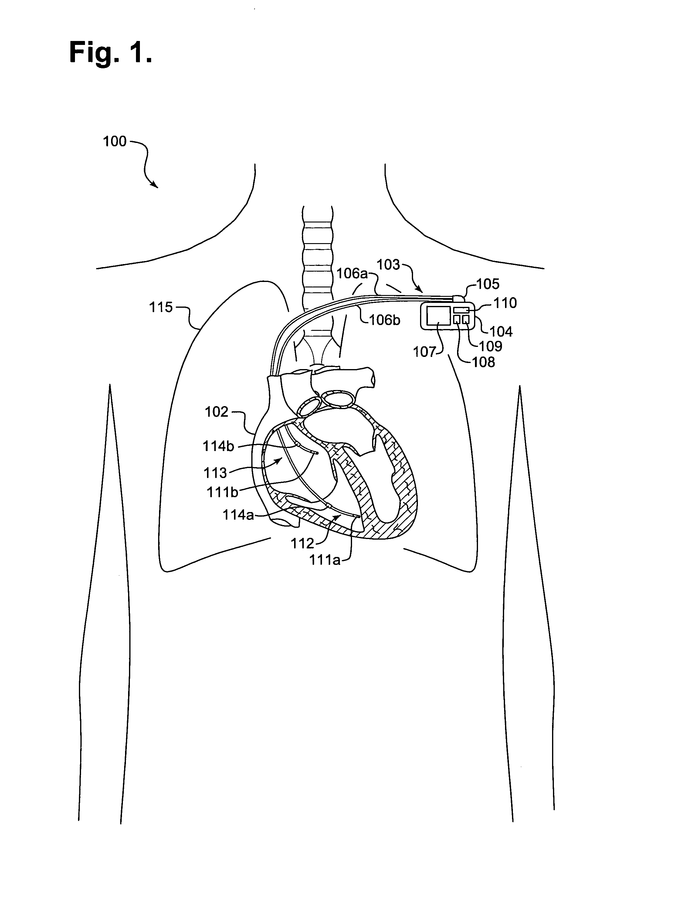 System and method for assessing pulmonary performance through transthoracic impedance monitoring