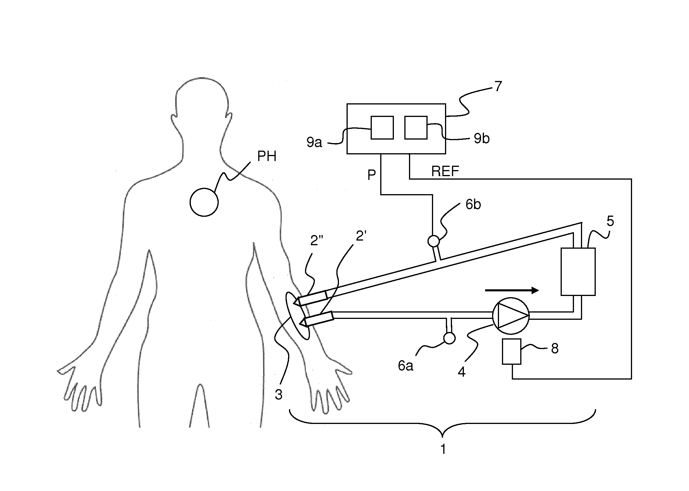 Separation of interference pulses from physiological pulses in a pressure signal