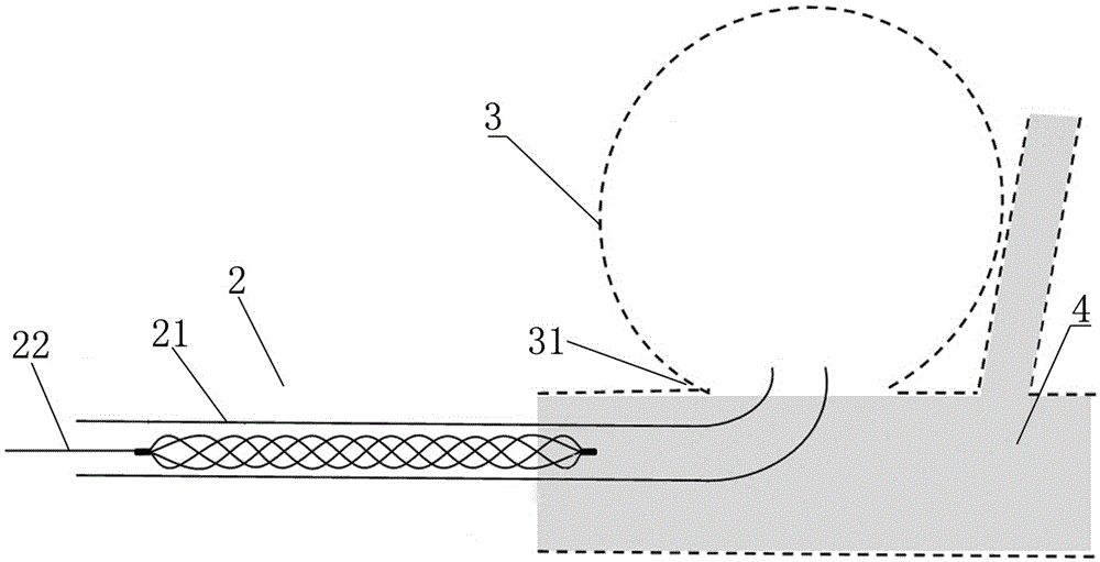 Intracranial aneurysm interventional embolization treatment device