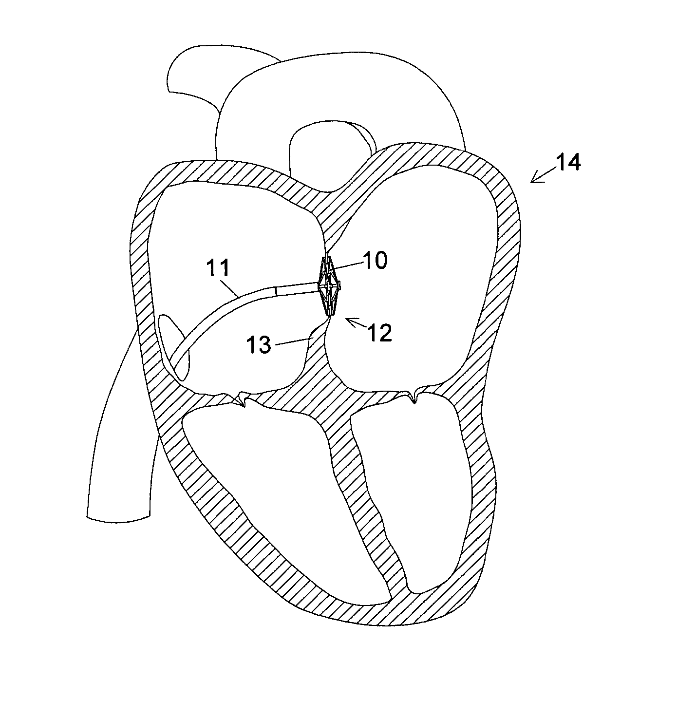 Closure device and insertion assembly