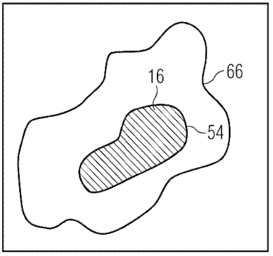 Method, image processing device and computed tomography system for determining a proportion of necrotic tissue as well as computer program product with program sections for determining a proportion of necrotic tissue