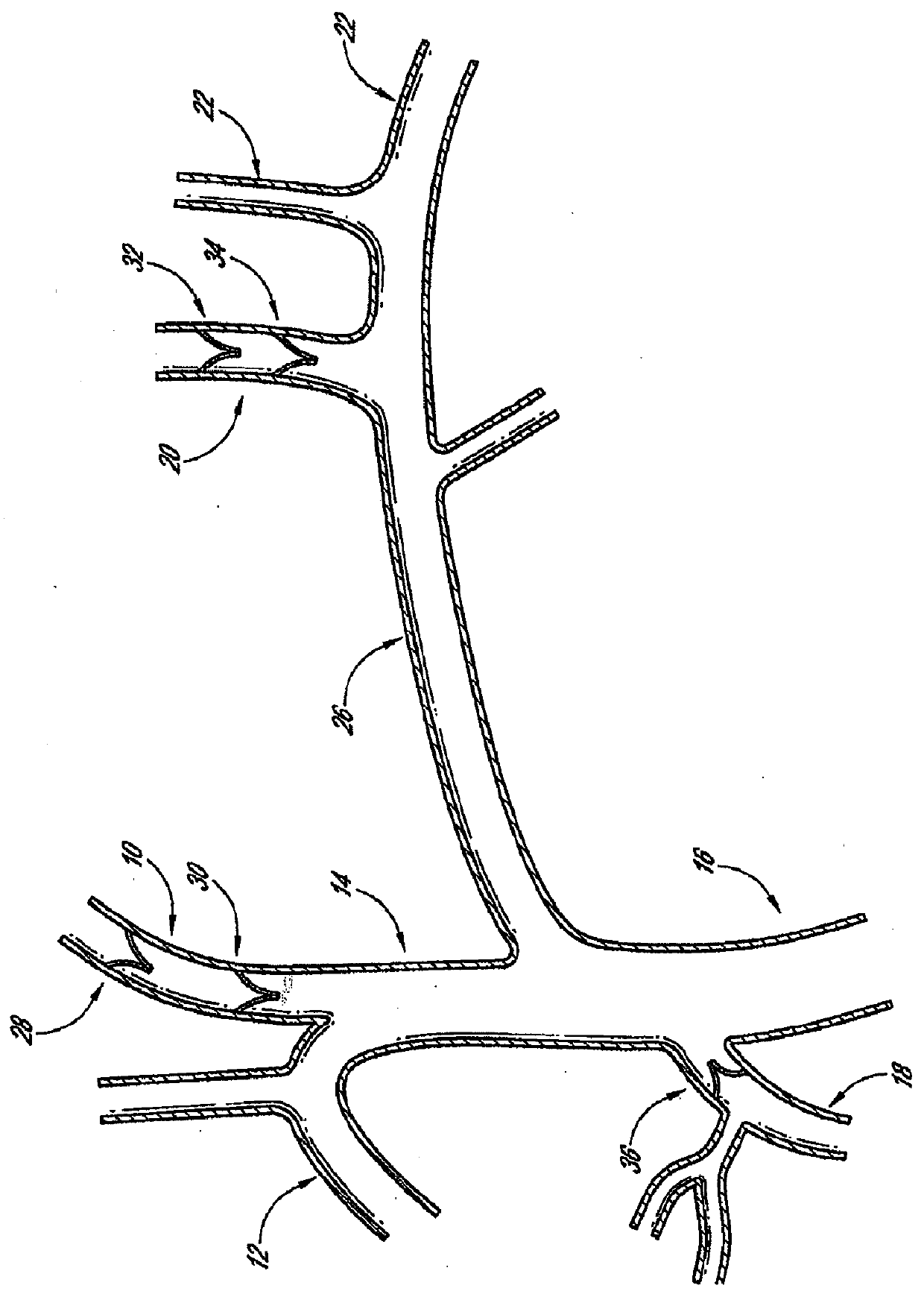 Methods and apparatus for treating neurovascular venous outflow obstruction