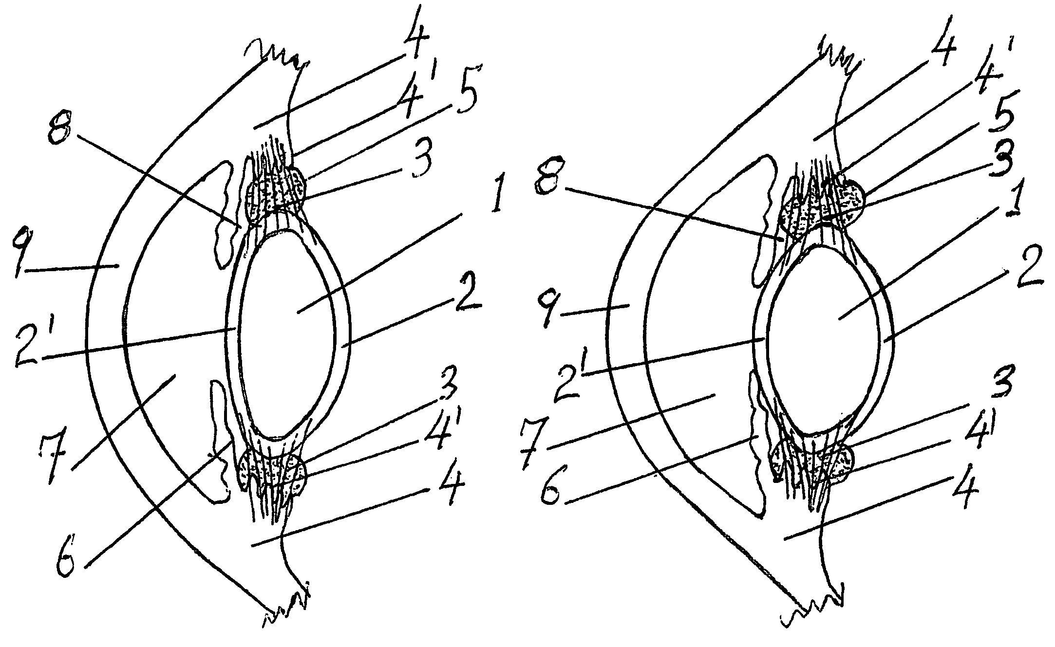 Accommodating zonular mini-bridge implants