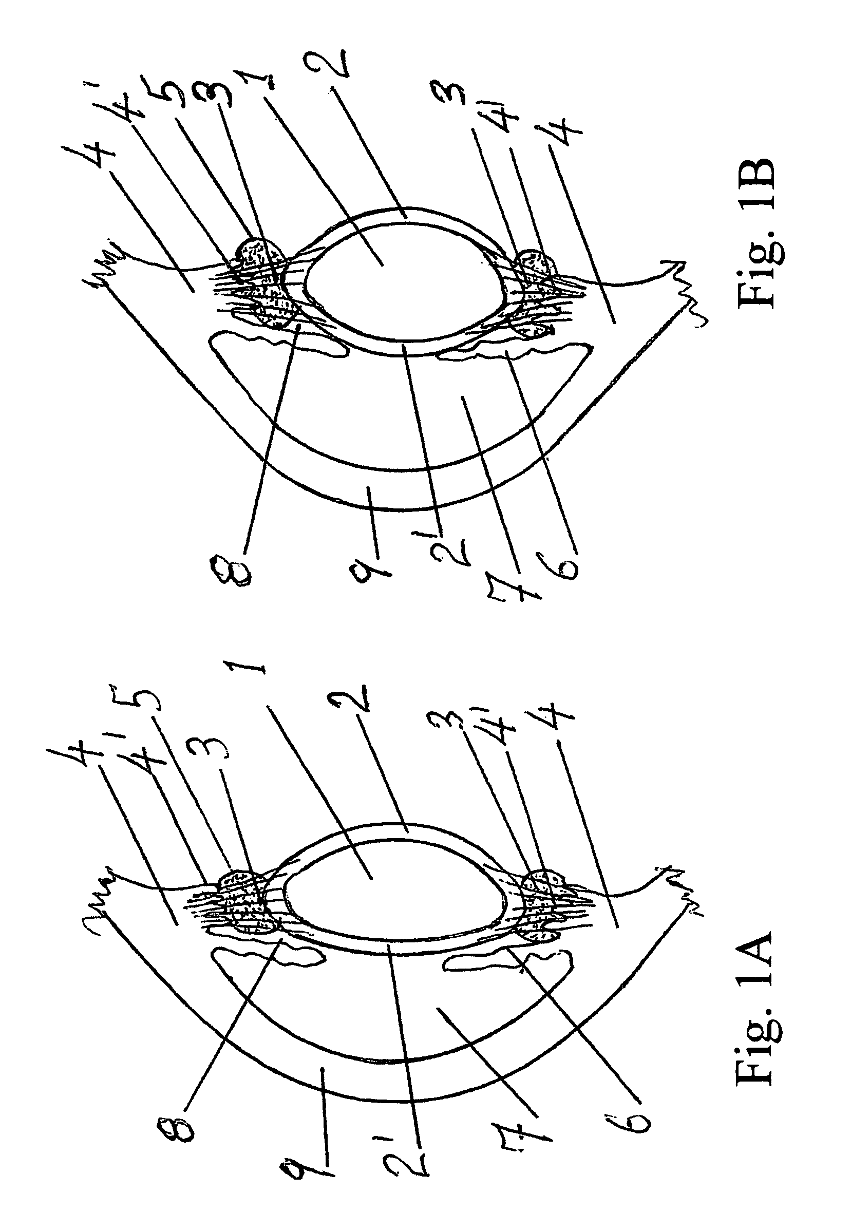 Accommodating zonular mini-bridge implants