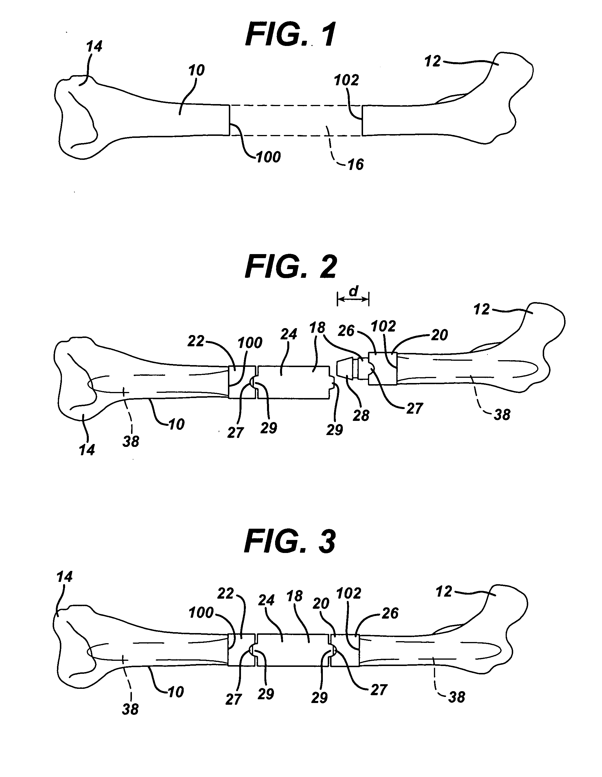 Orthopaedic spacer