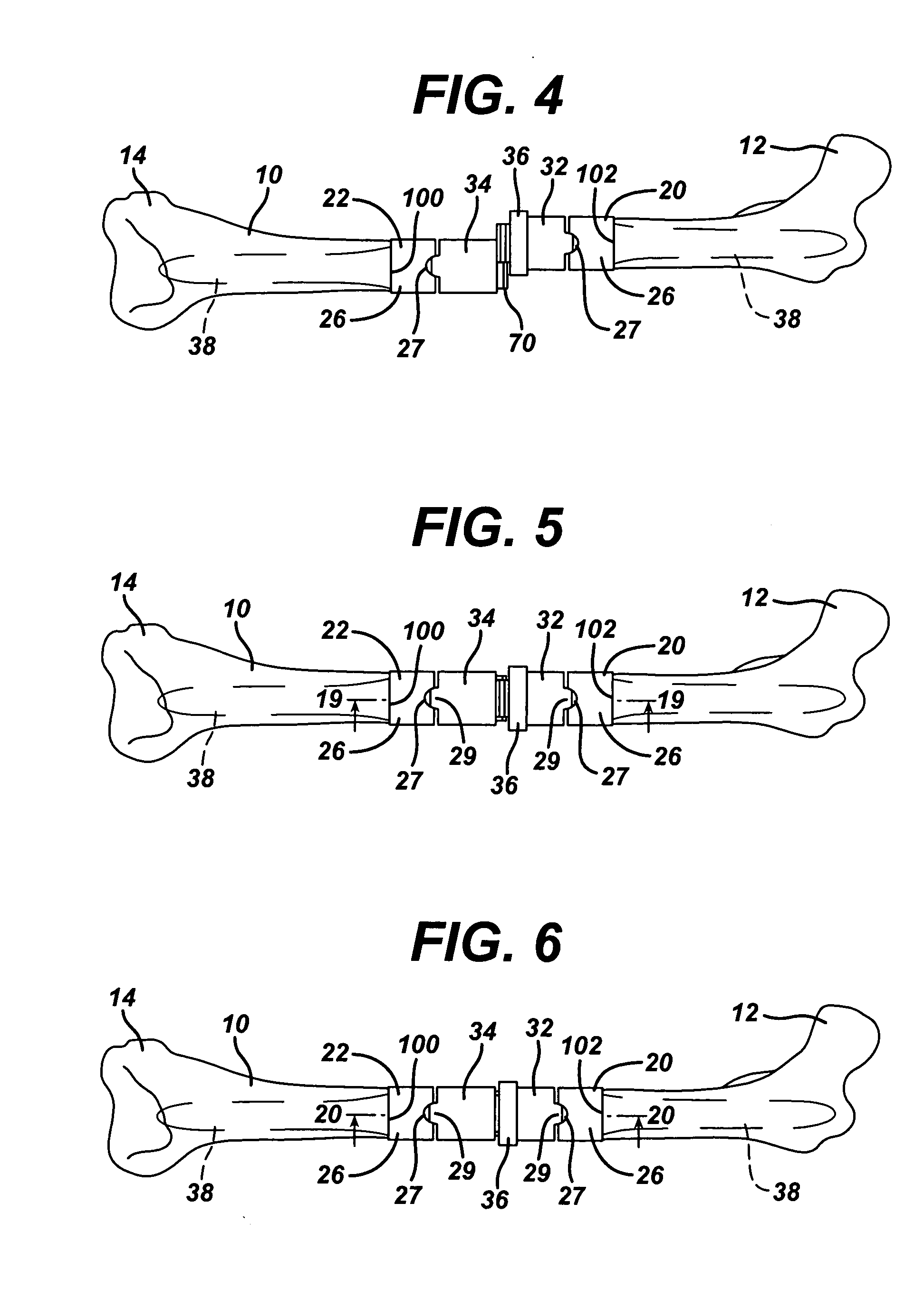 Orthopaedic spacer