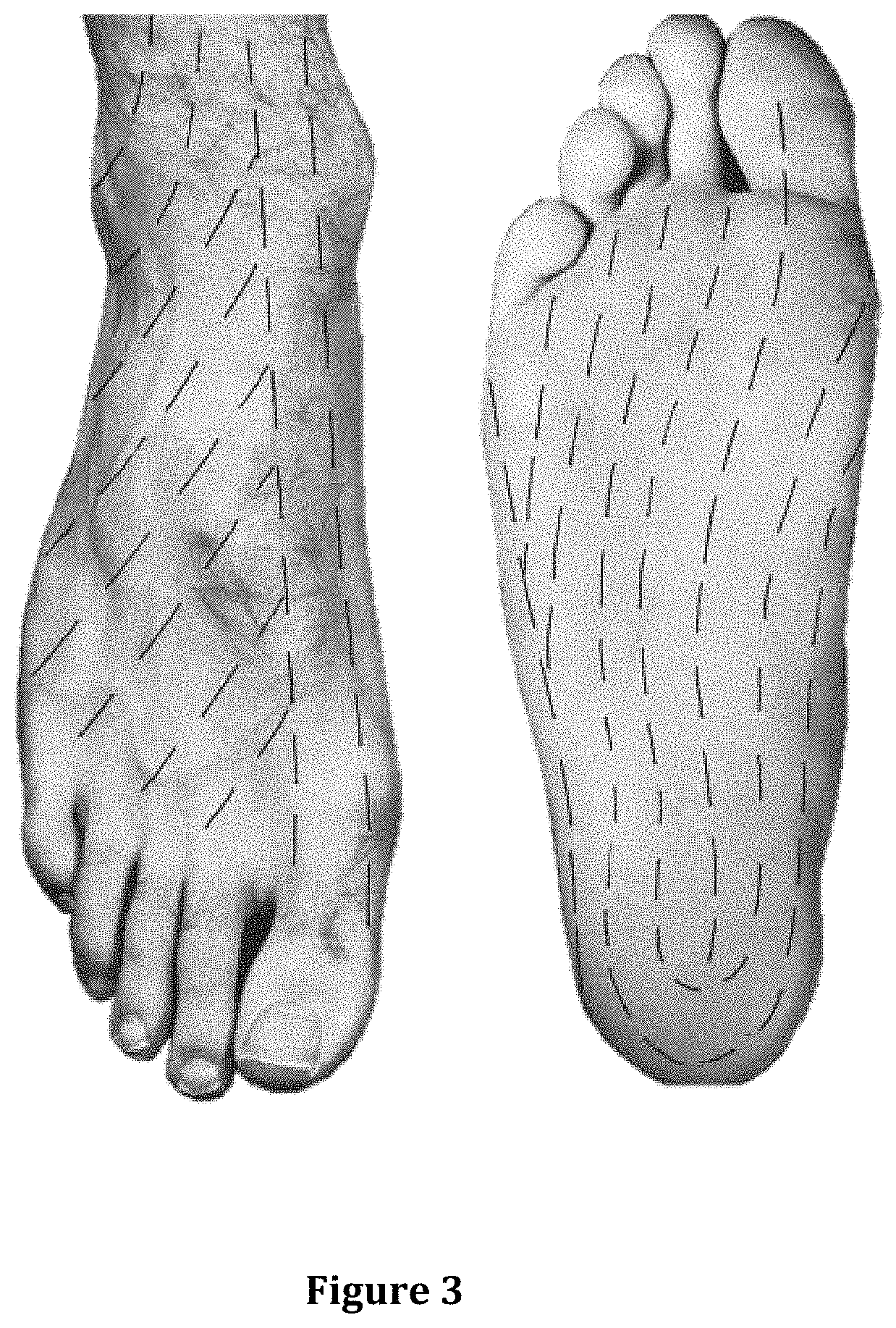 Apical surgical wound debridement