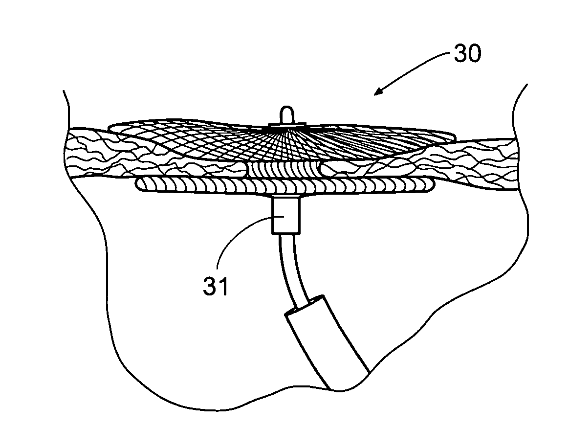 Devices, systems, and methods for reshaping a heart valve annulus, including the use of an adjustable bridge implant system