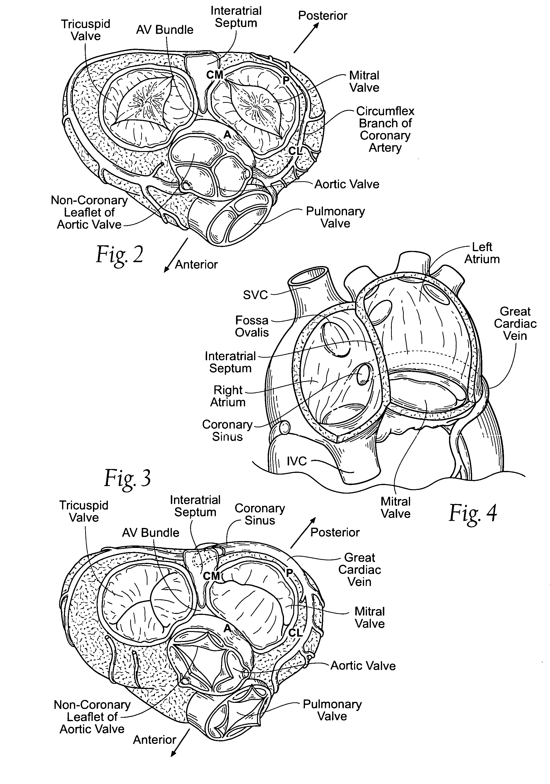 Devices, systems, and methods for reshaping a heart valve annulus, including the use of an adjustable bridge implant system