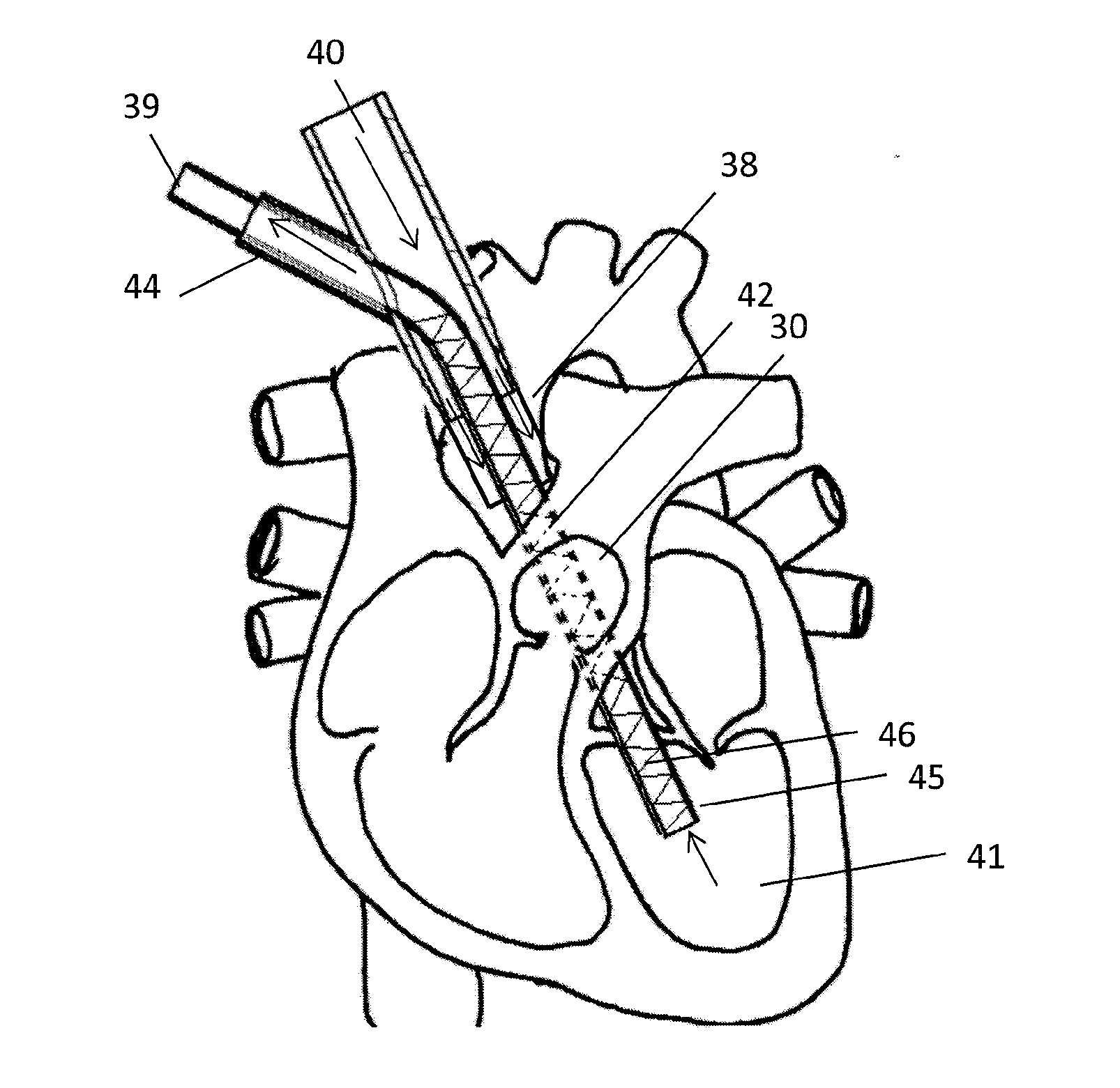 Self-expanding cannula