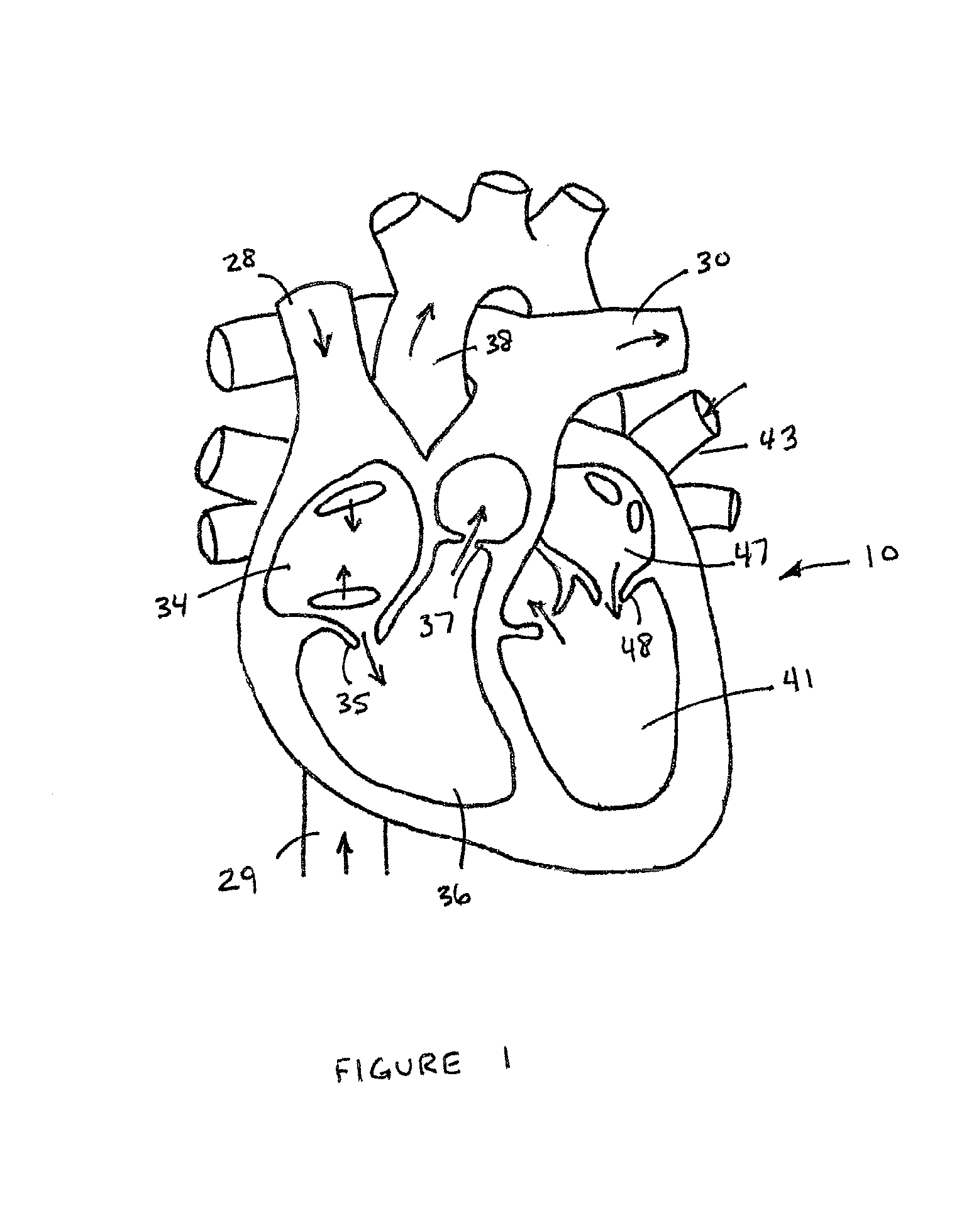 Self-expanding cannula