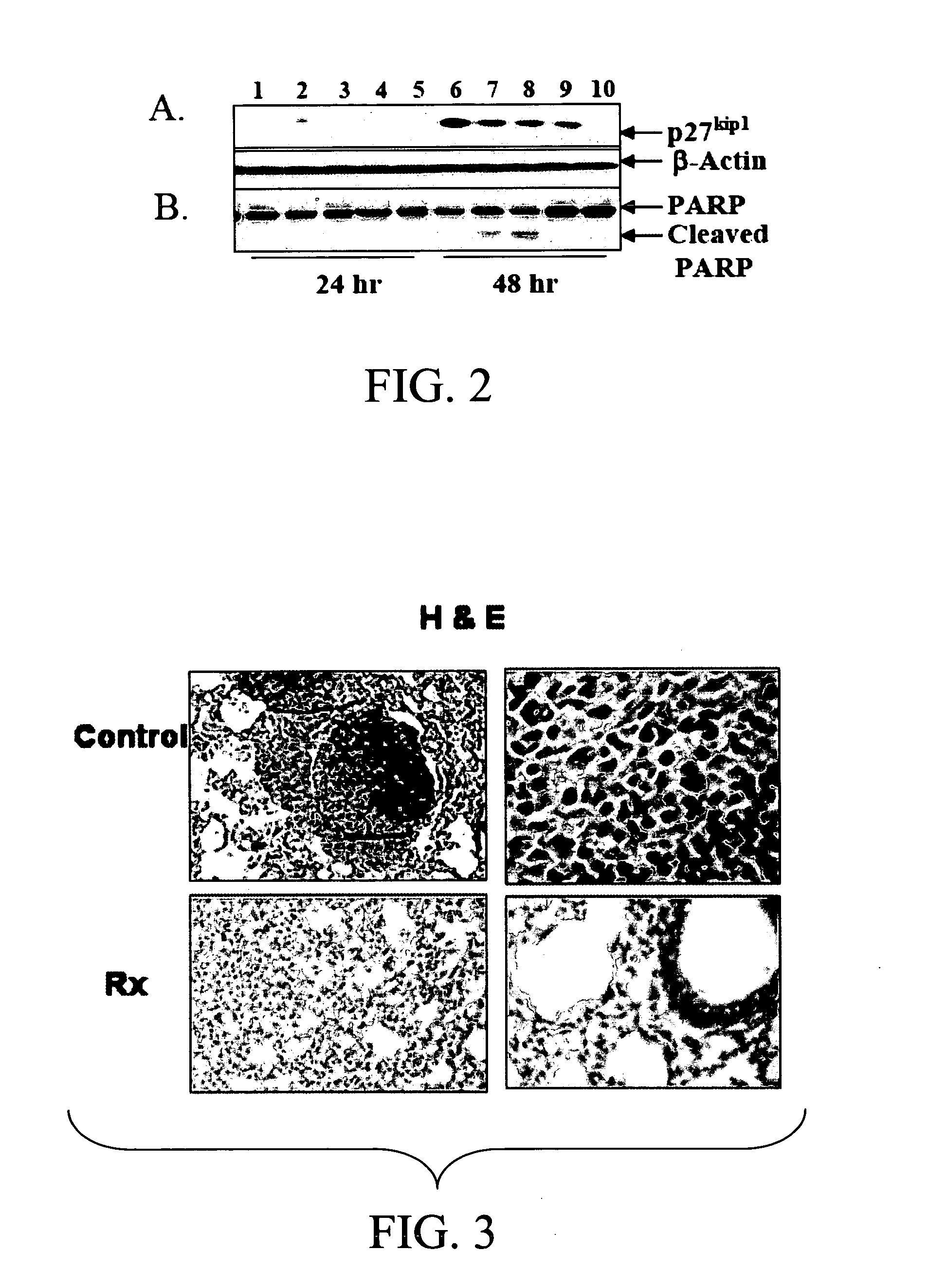 Nanogene therapy for cell proliferation disorders