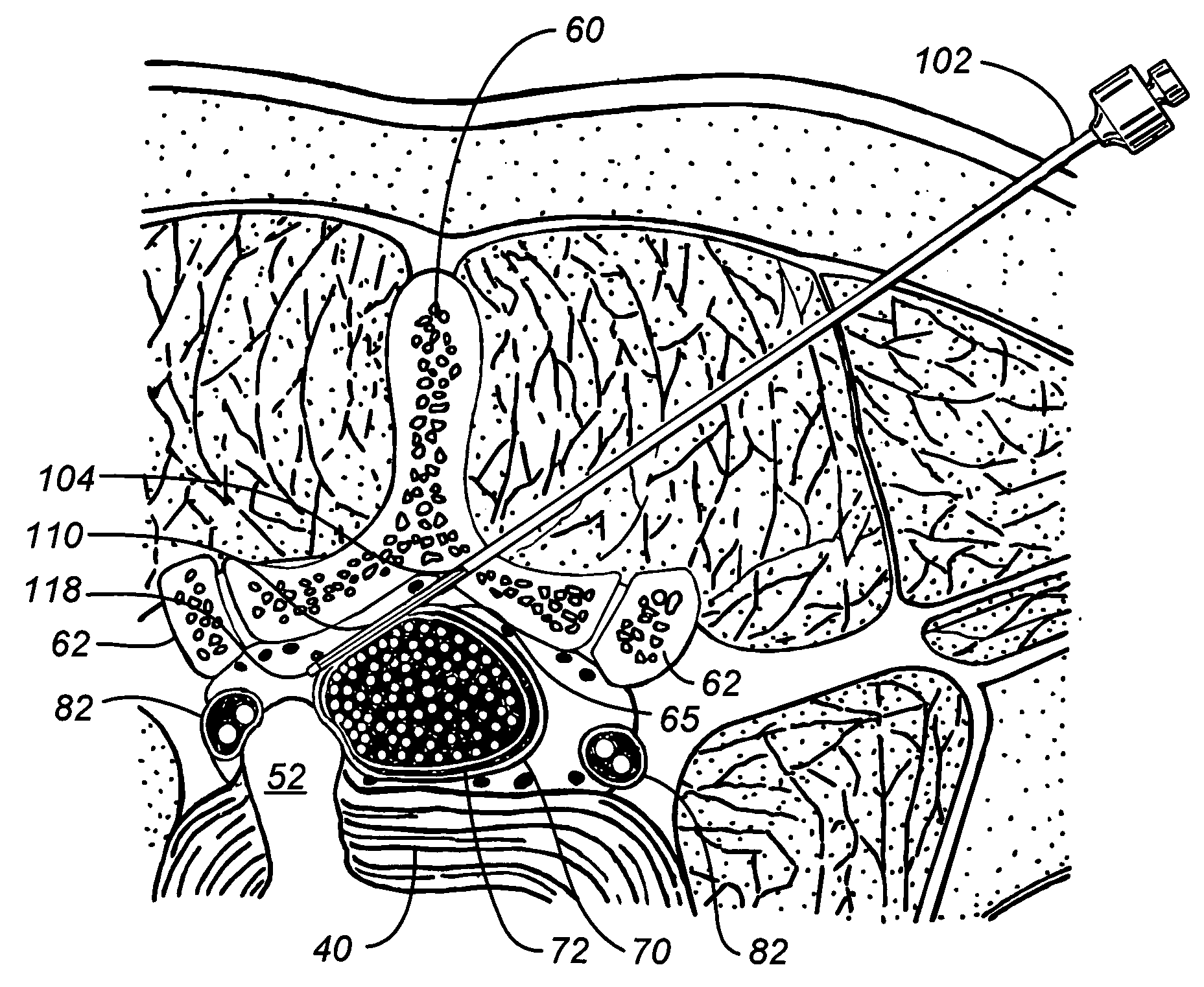 Percutaneous endoscopic access tools for the spinal epidural space and related methods of treatment