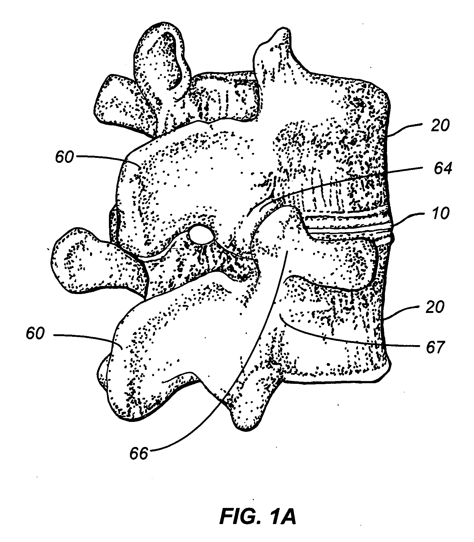 Percutaneous endoscopic access tools for the spinal epidural space and related methods of treatment