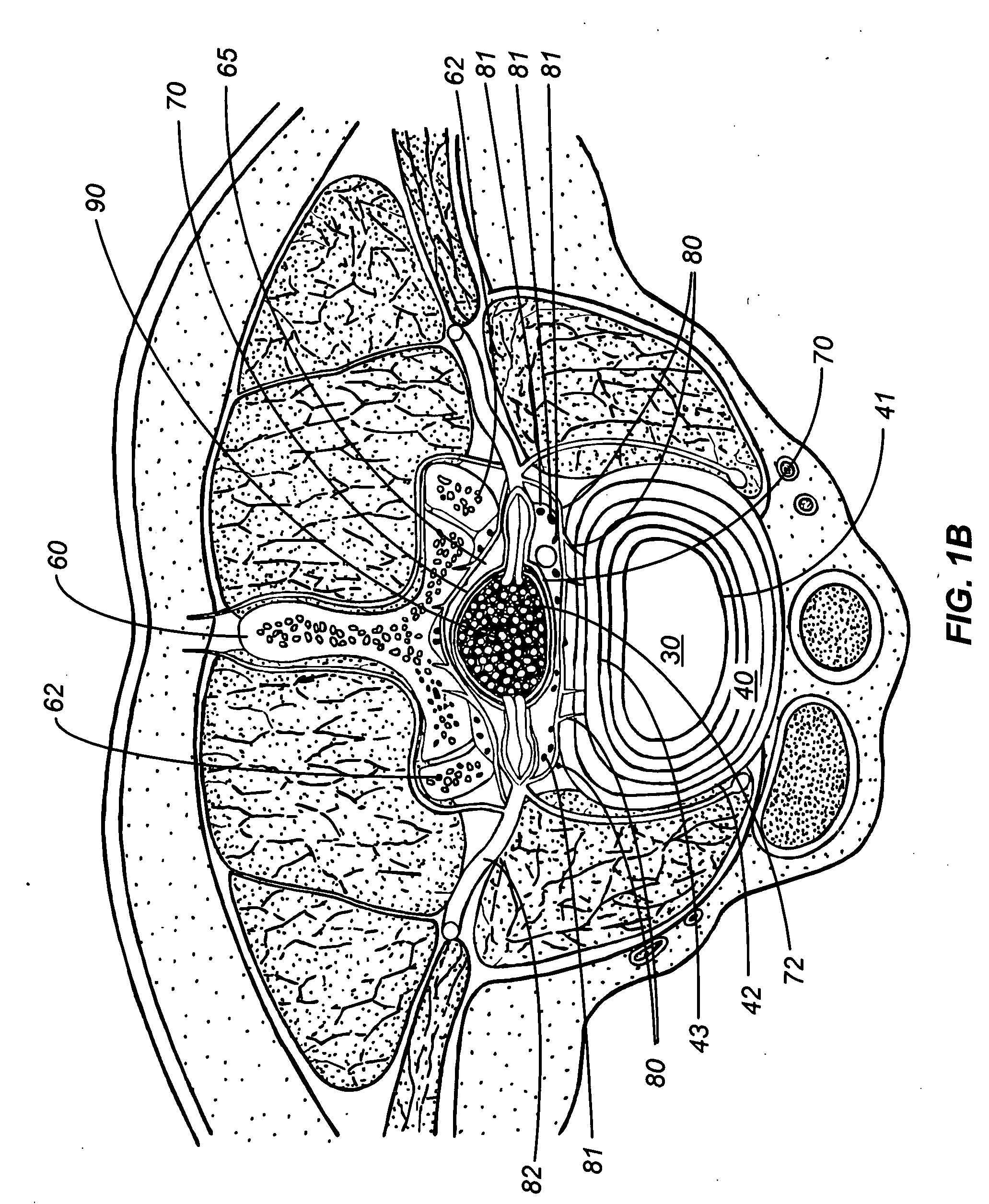 Percutaneous endoscopic access tools for the spinal epidural space and related methods of treatment