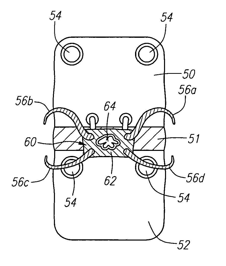 Sutures for use in the repair of defects in the anulus fibrosus