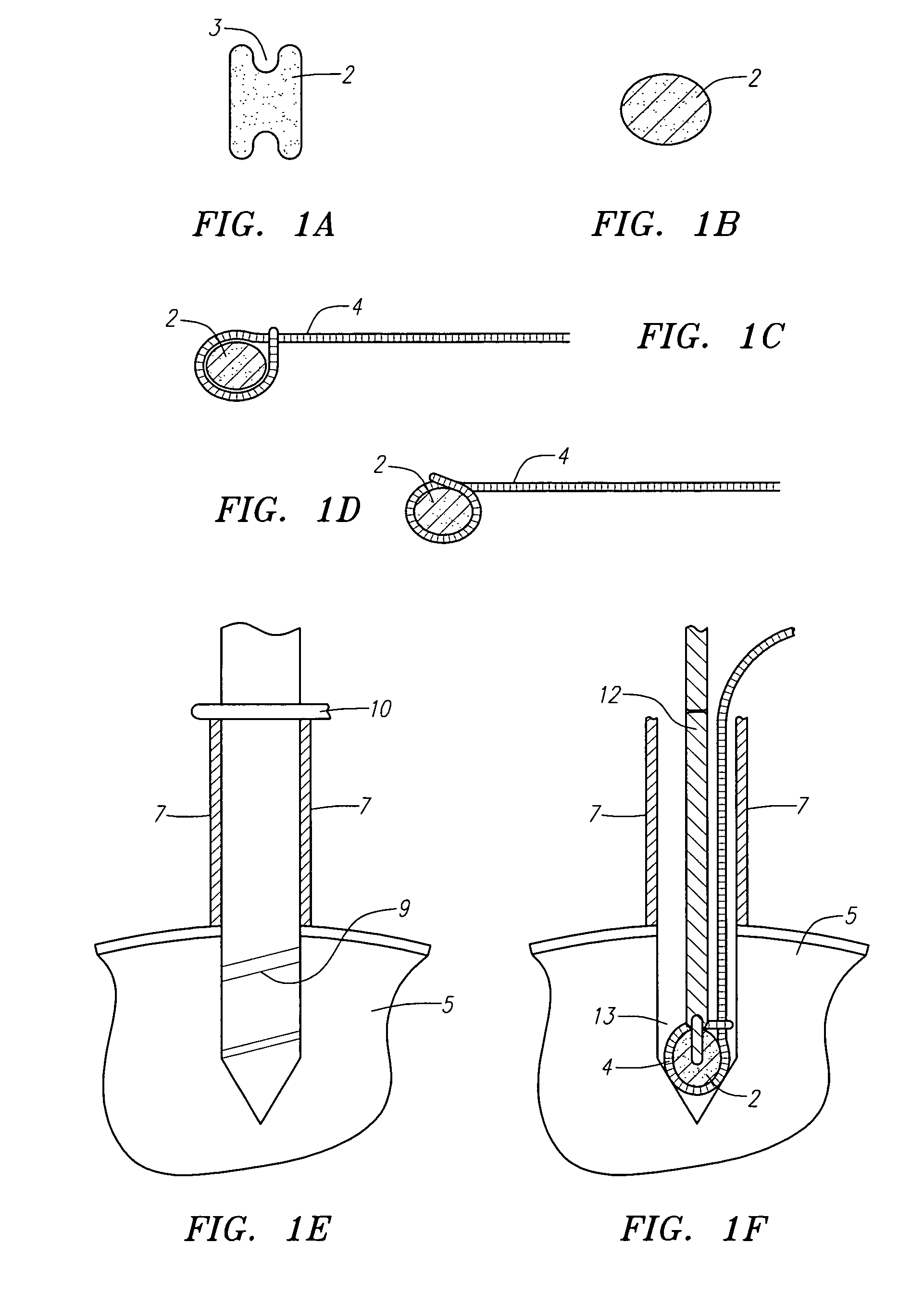 Sutures for use in the repair of defects in the anulus fibrosus