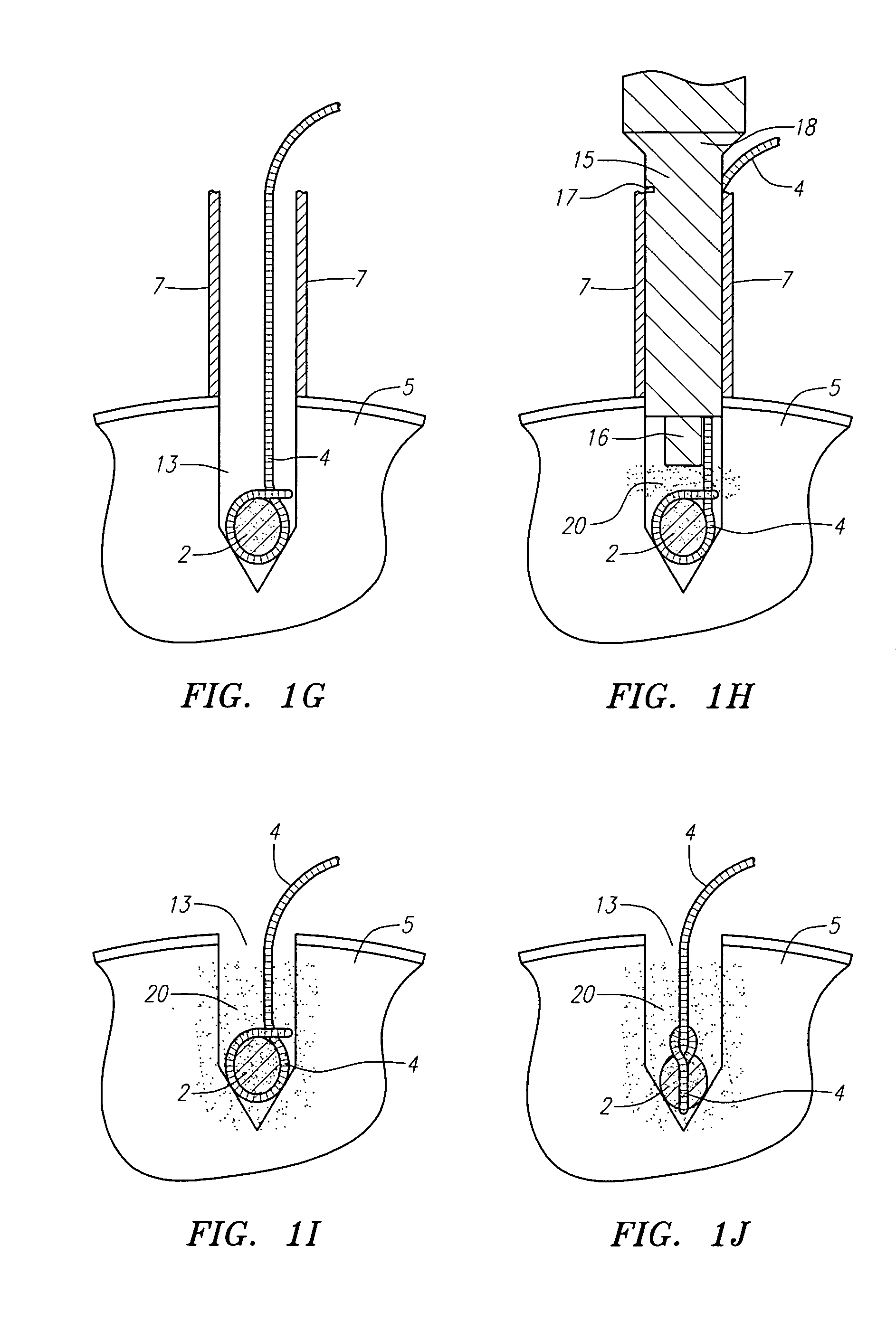 Sutures for use in the repair of defects in the anulus fibrosus