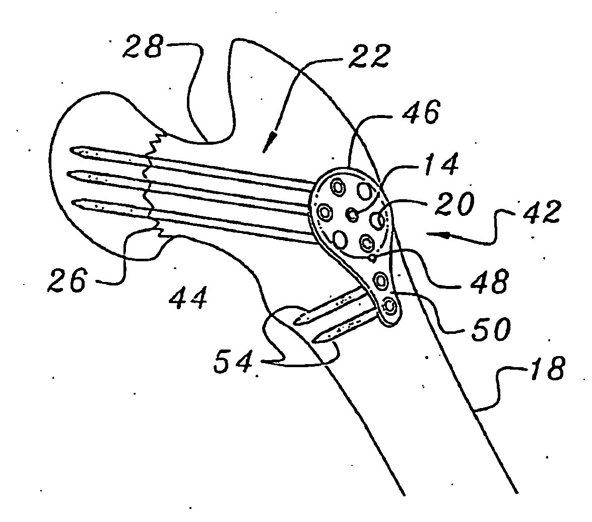 Bone end (epiphysis) fracture fixation device and method of use