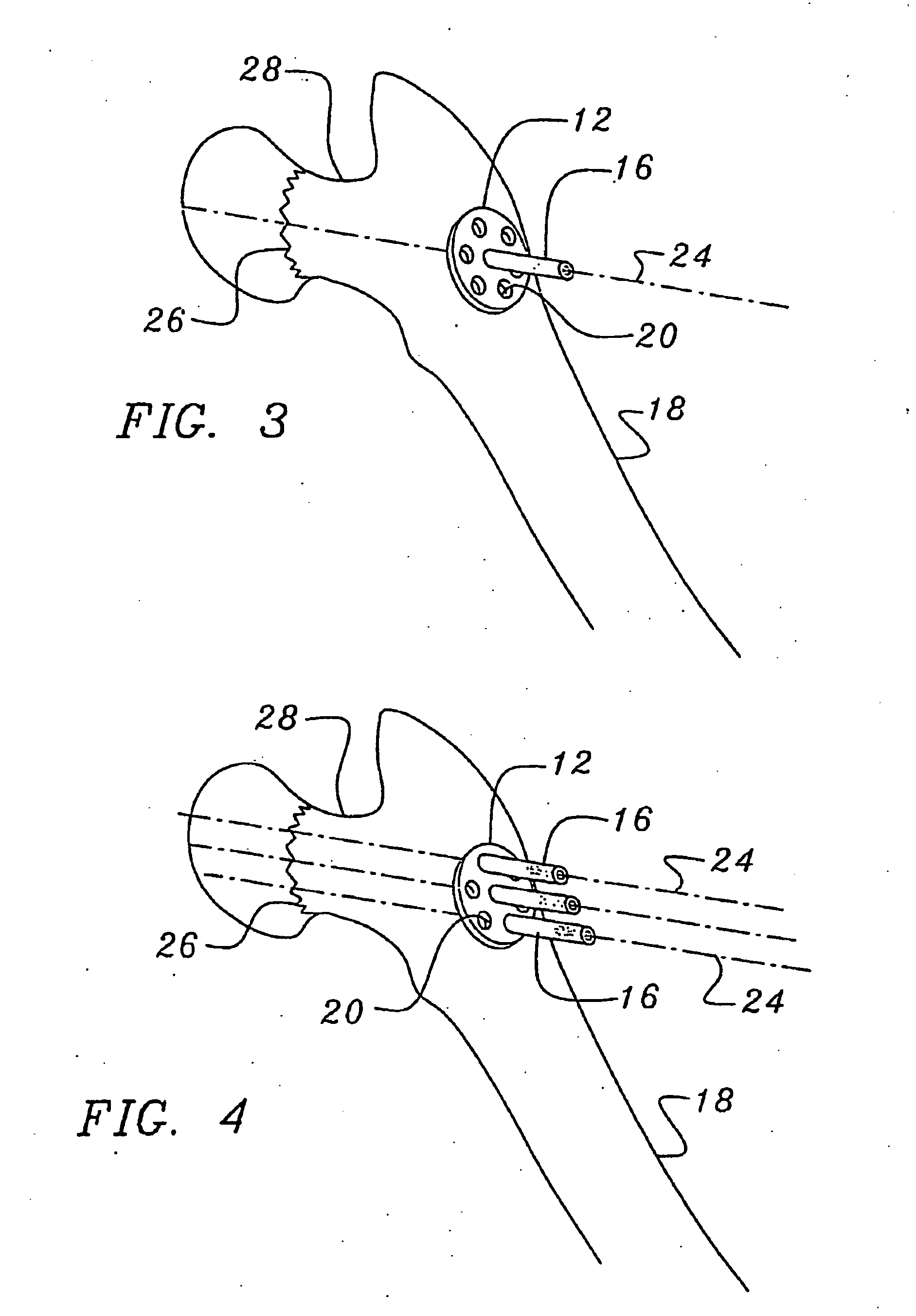 Bone end (epiphysis) fracture fixation device and method of use