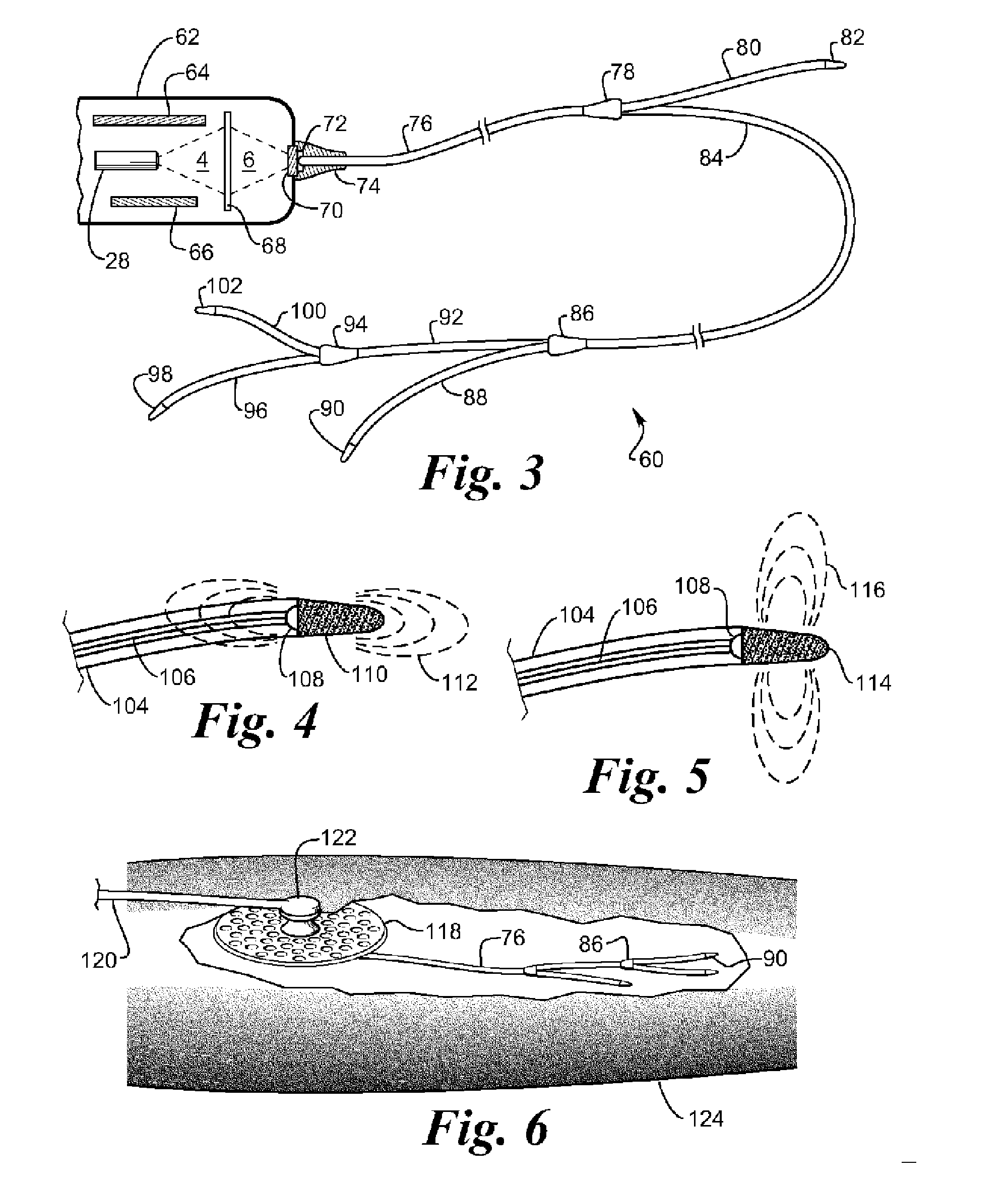 Pyrode neurostimulator