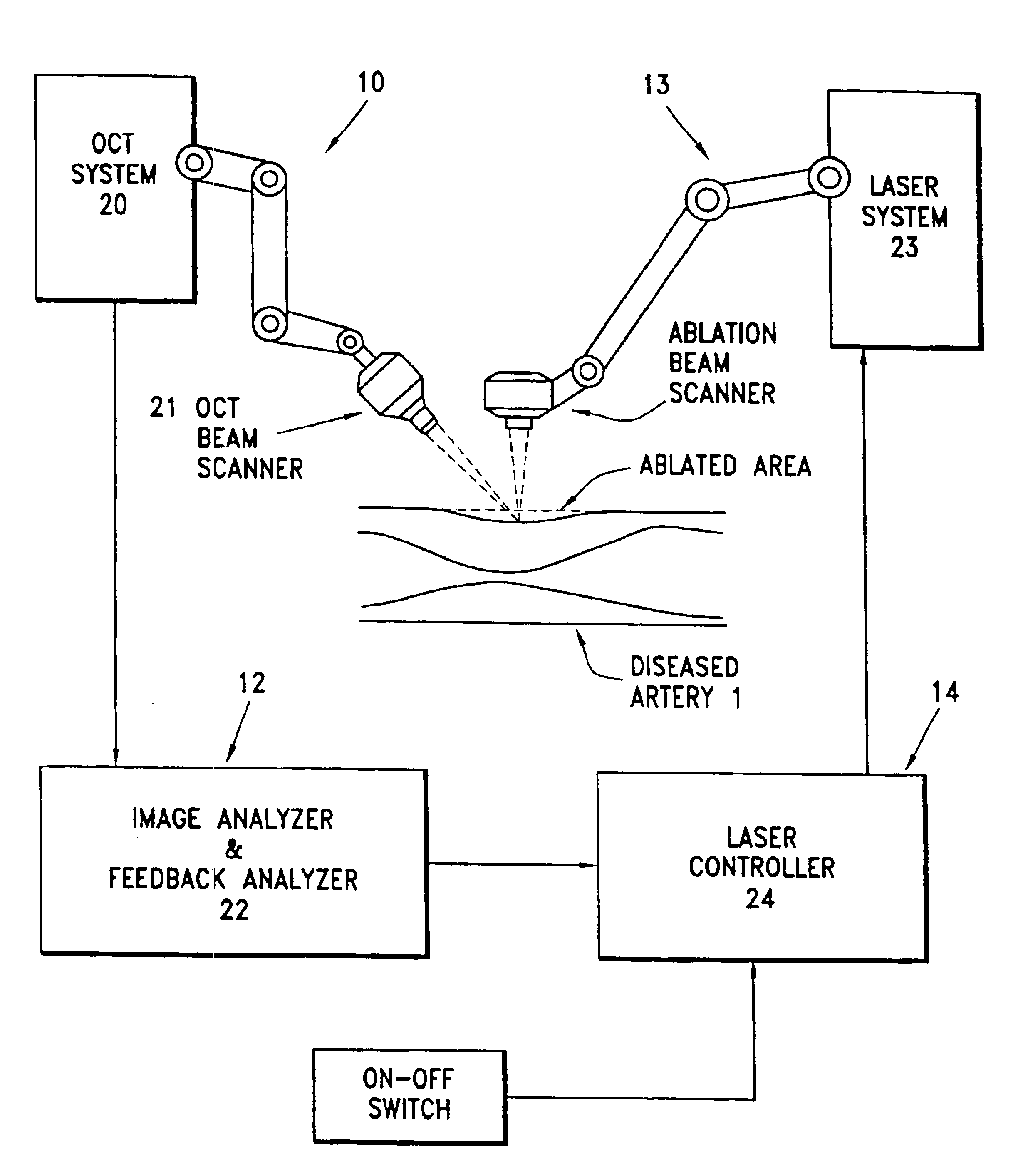 Apparatus for exterior arterial ablation