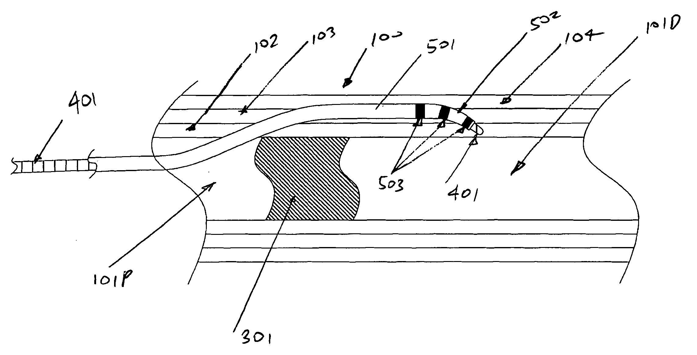 Device and method for vascular re-entry