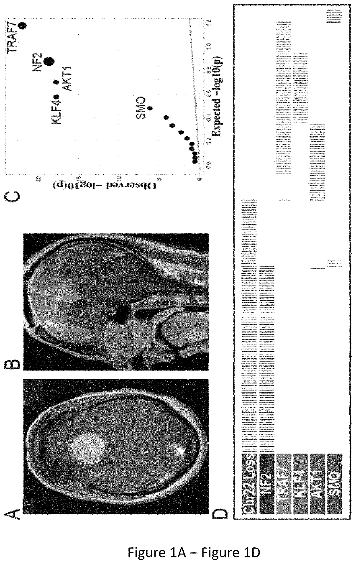 Compositions and methods for diagnosing and treating meningioma