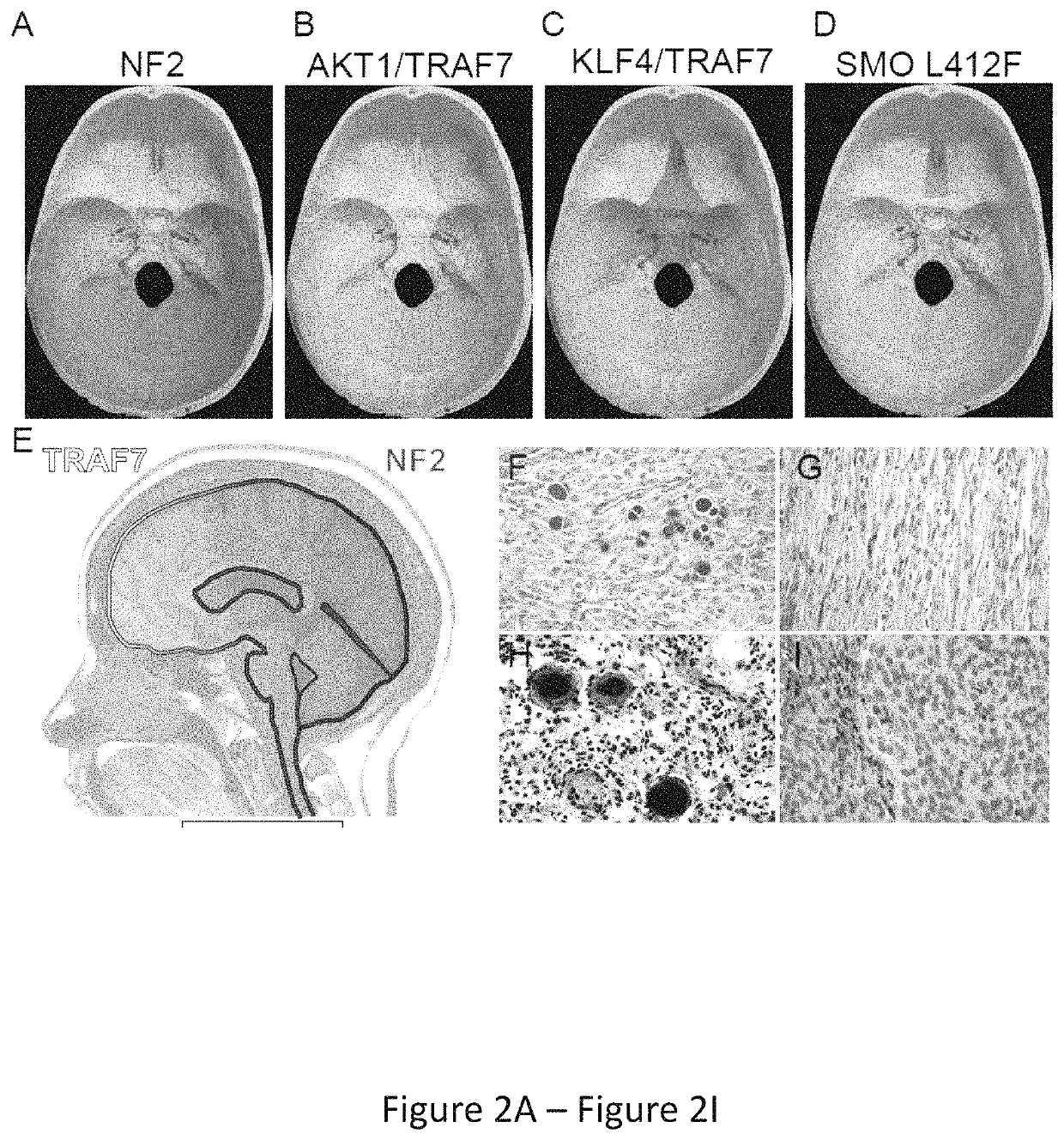 Compositions and methods for diagnosing and treating meningioma