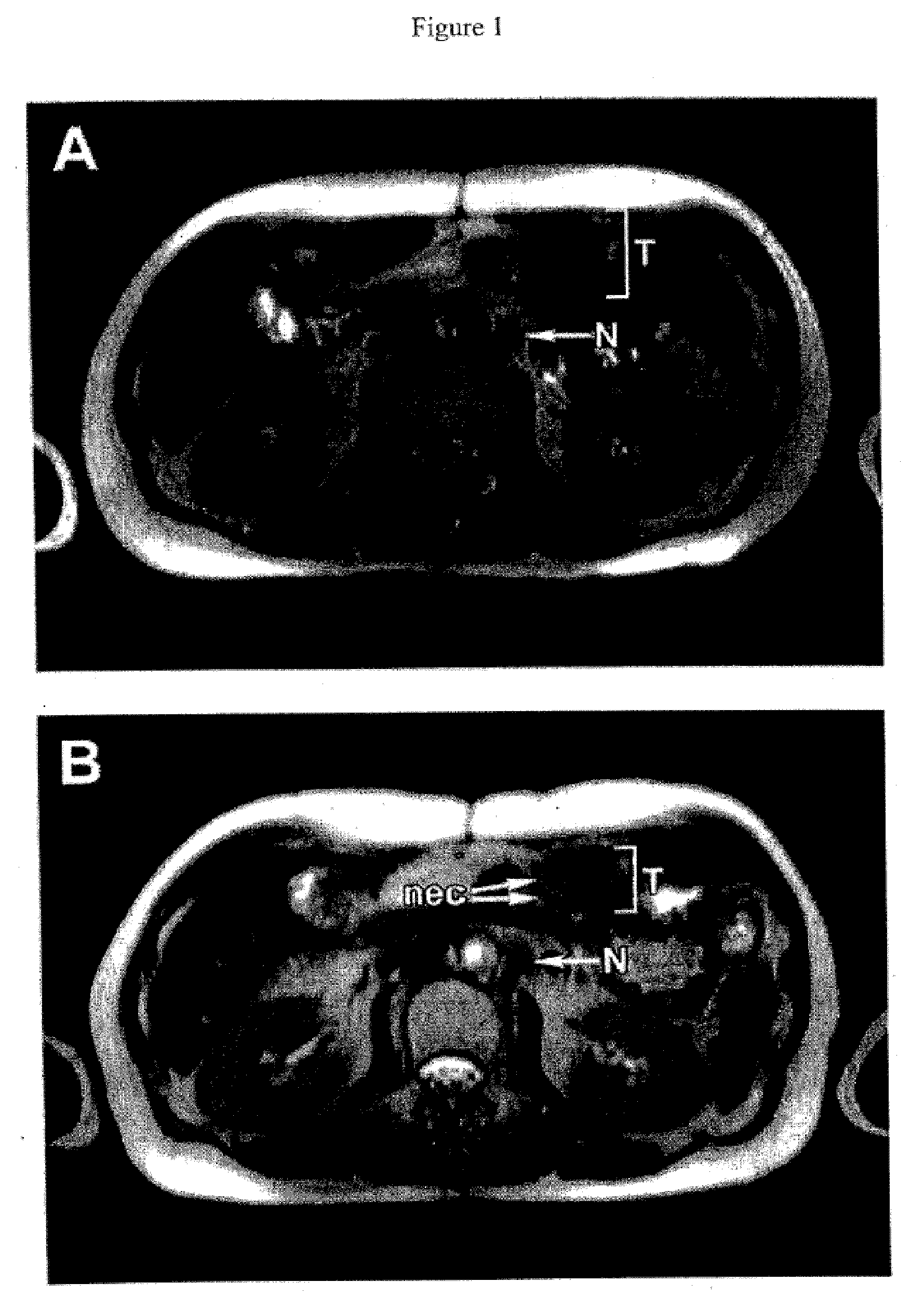 Pathotropic targeted gene delivery system for cancer and other disorders