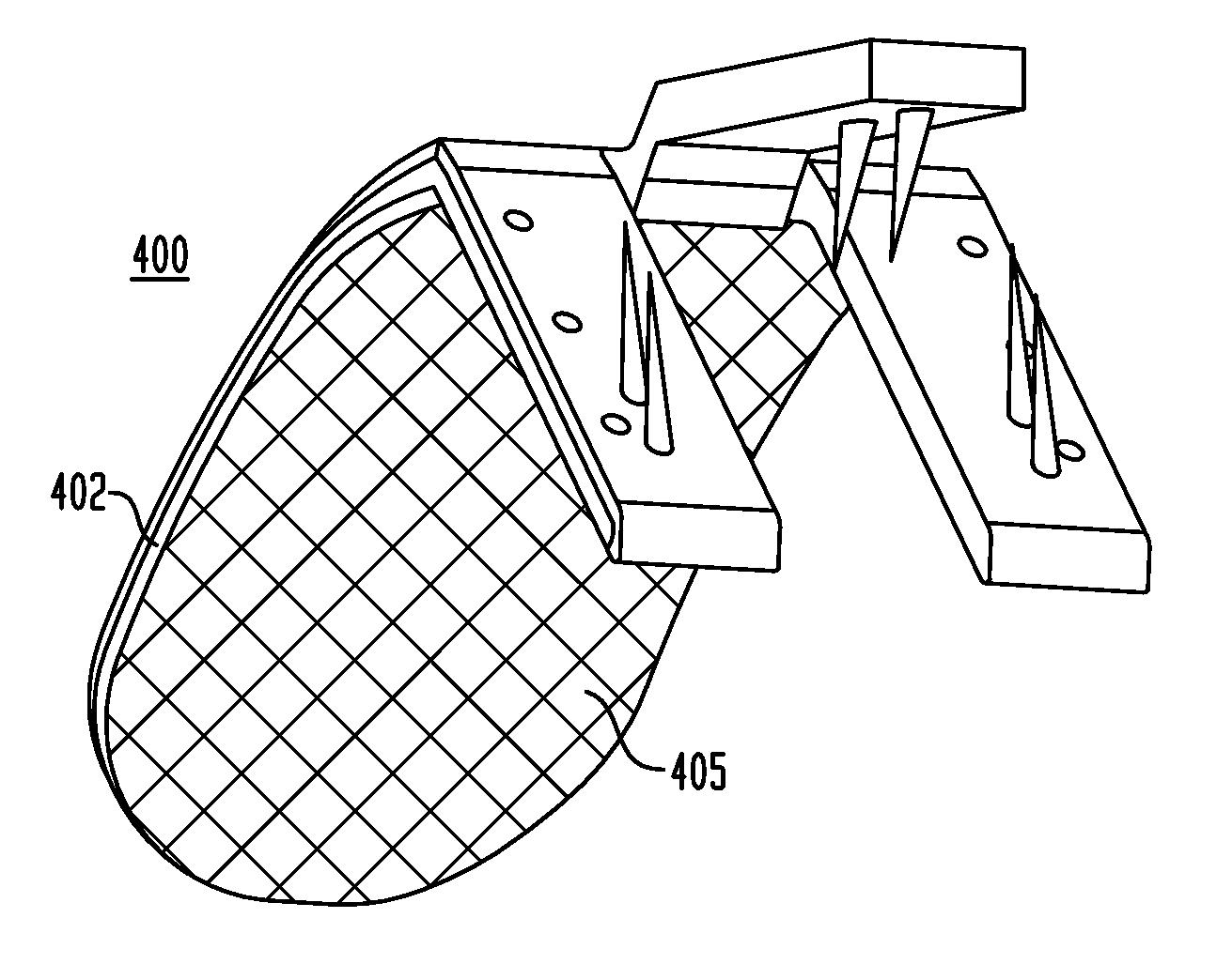 Implant systems and methods for treating obstructive sleep apnea