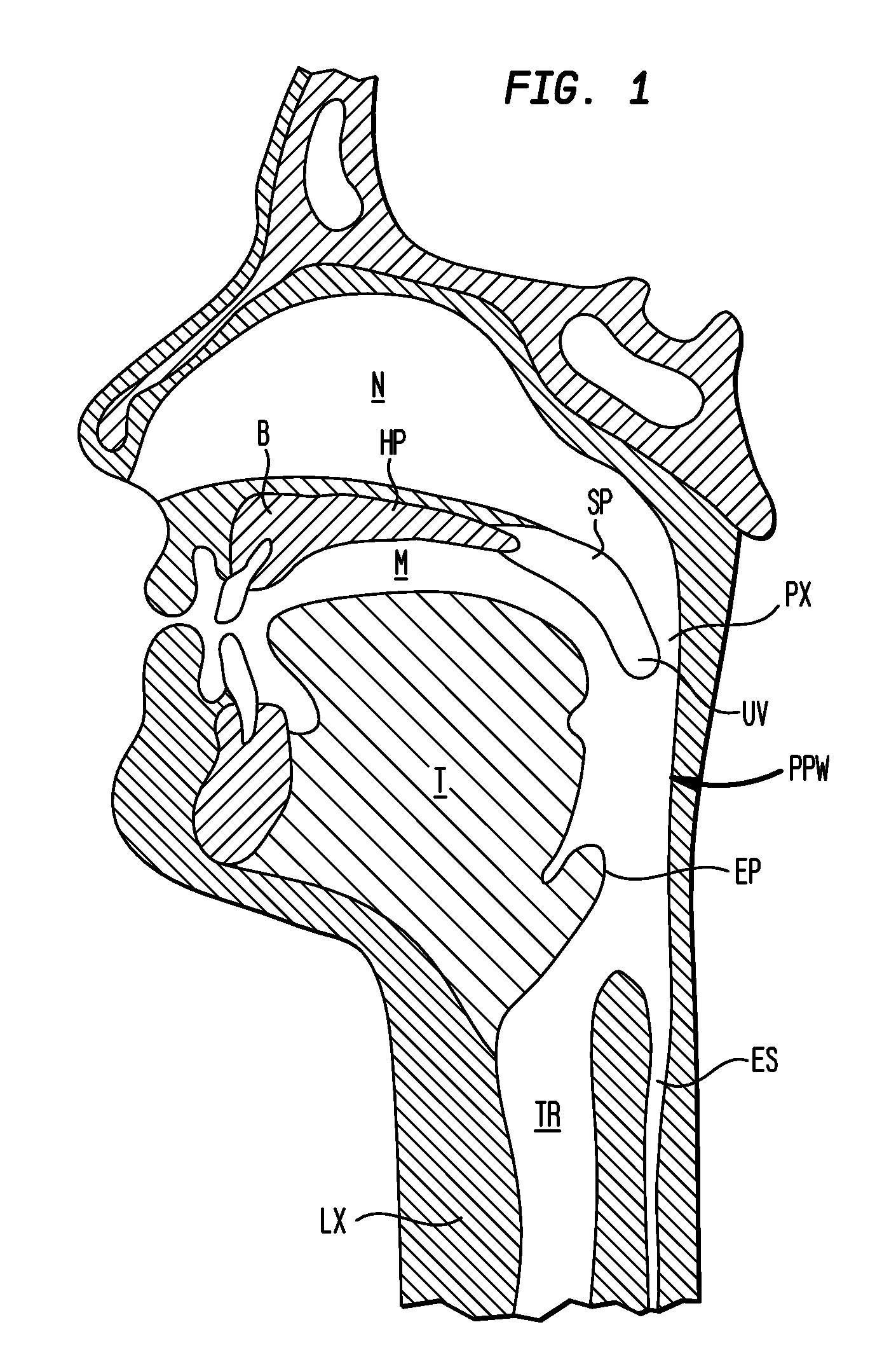 Implant systems and methods for treating obstructive sleep apnea