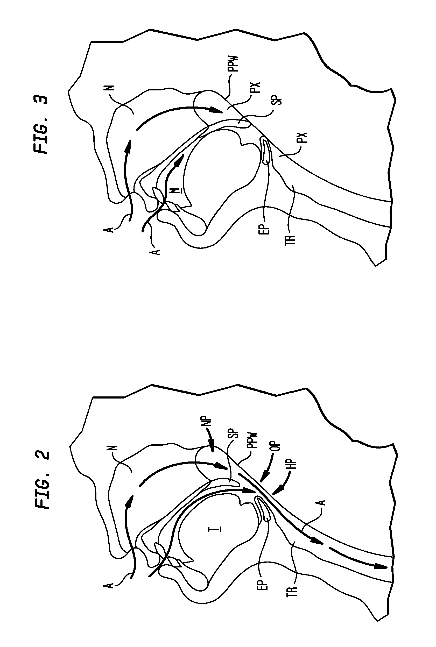 Implant systems and methods for treating obstructive sleep apnea