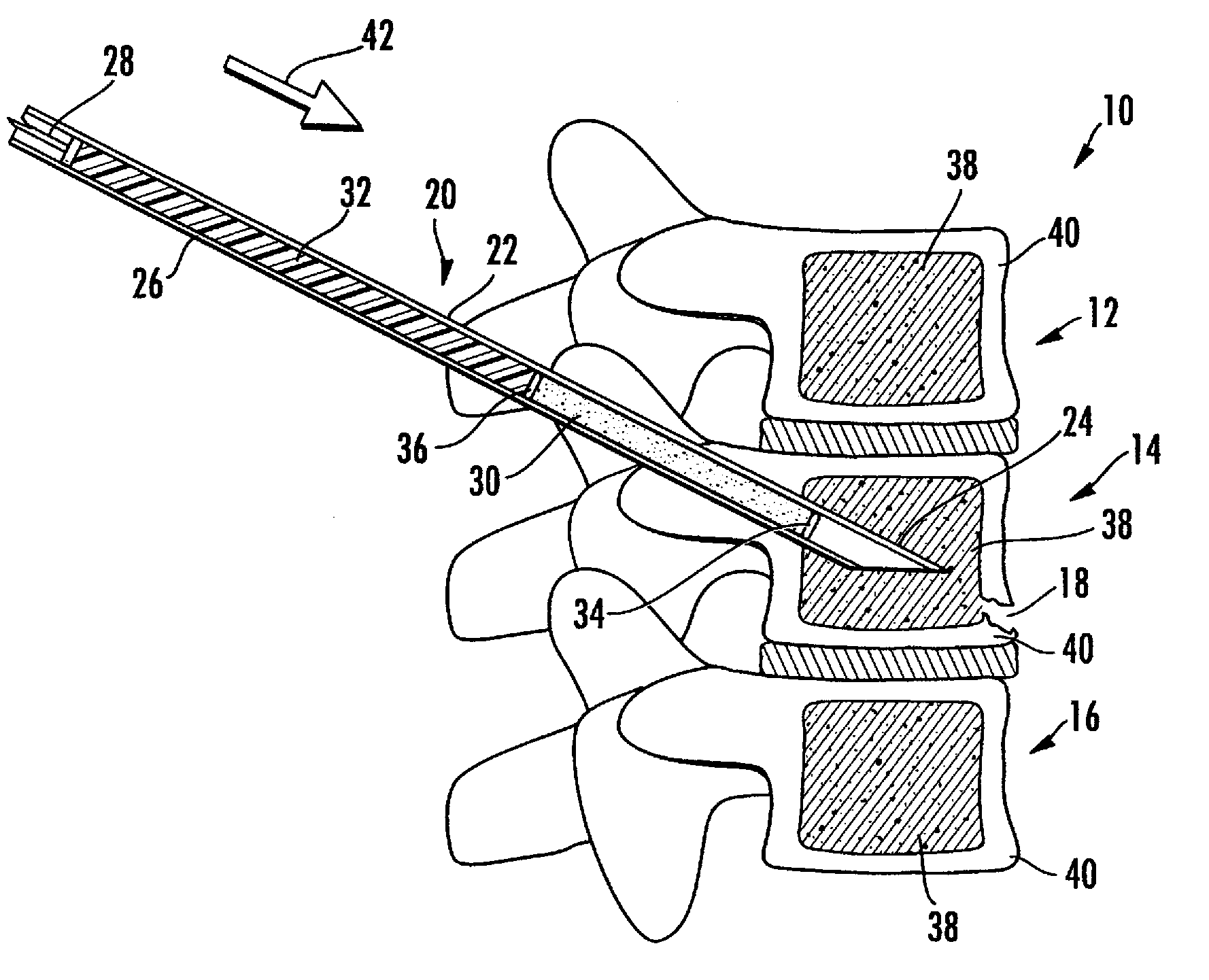Method and composition for use in reinforcing bone